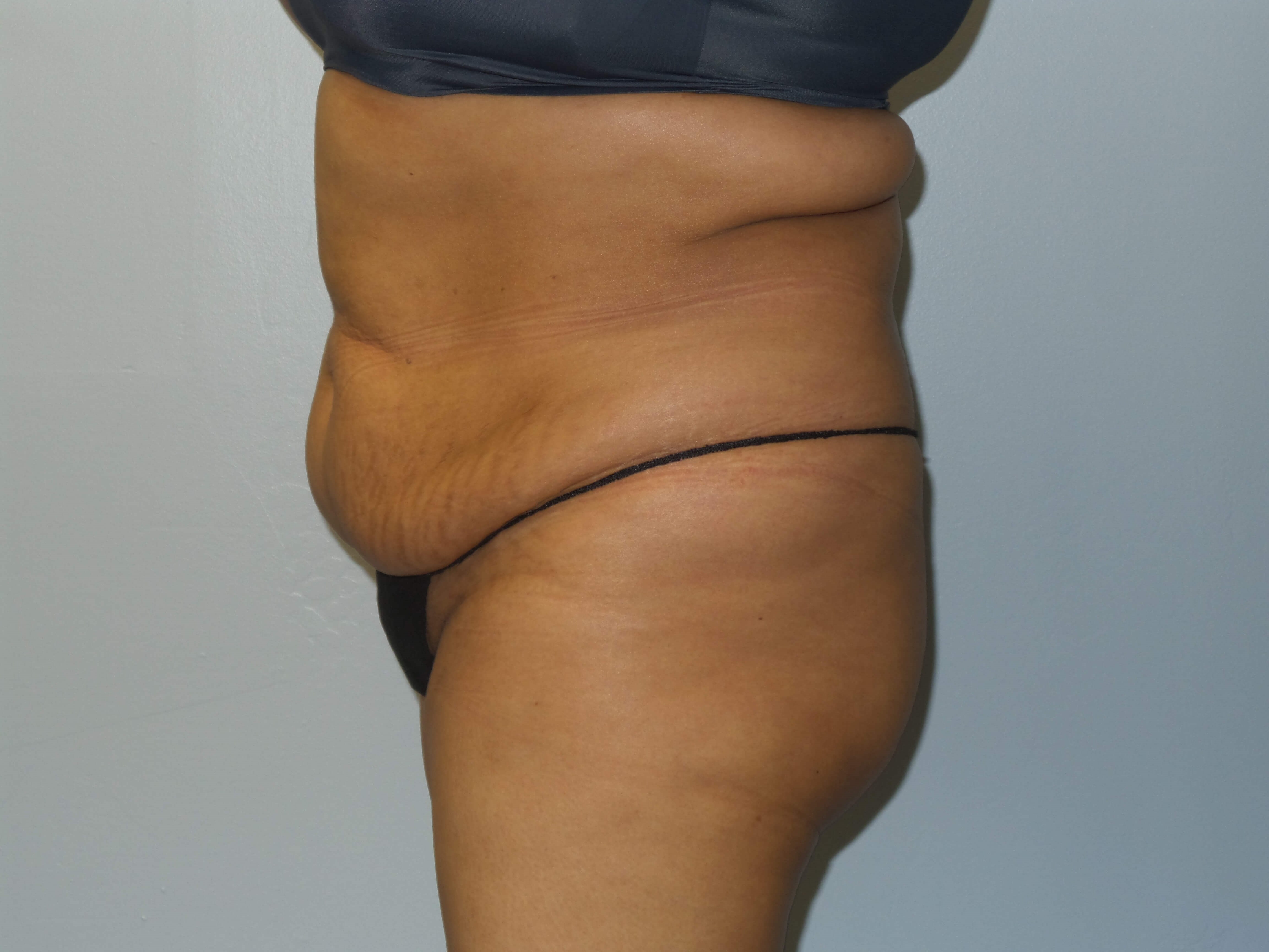 Woman Has Tummy Tuck Lipo Before