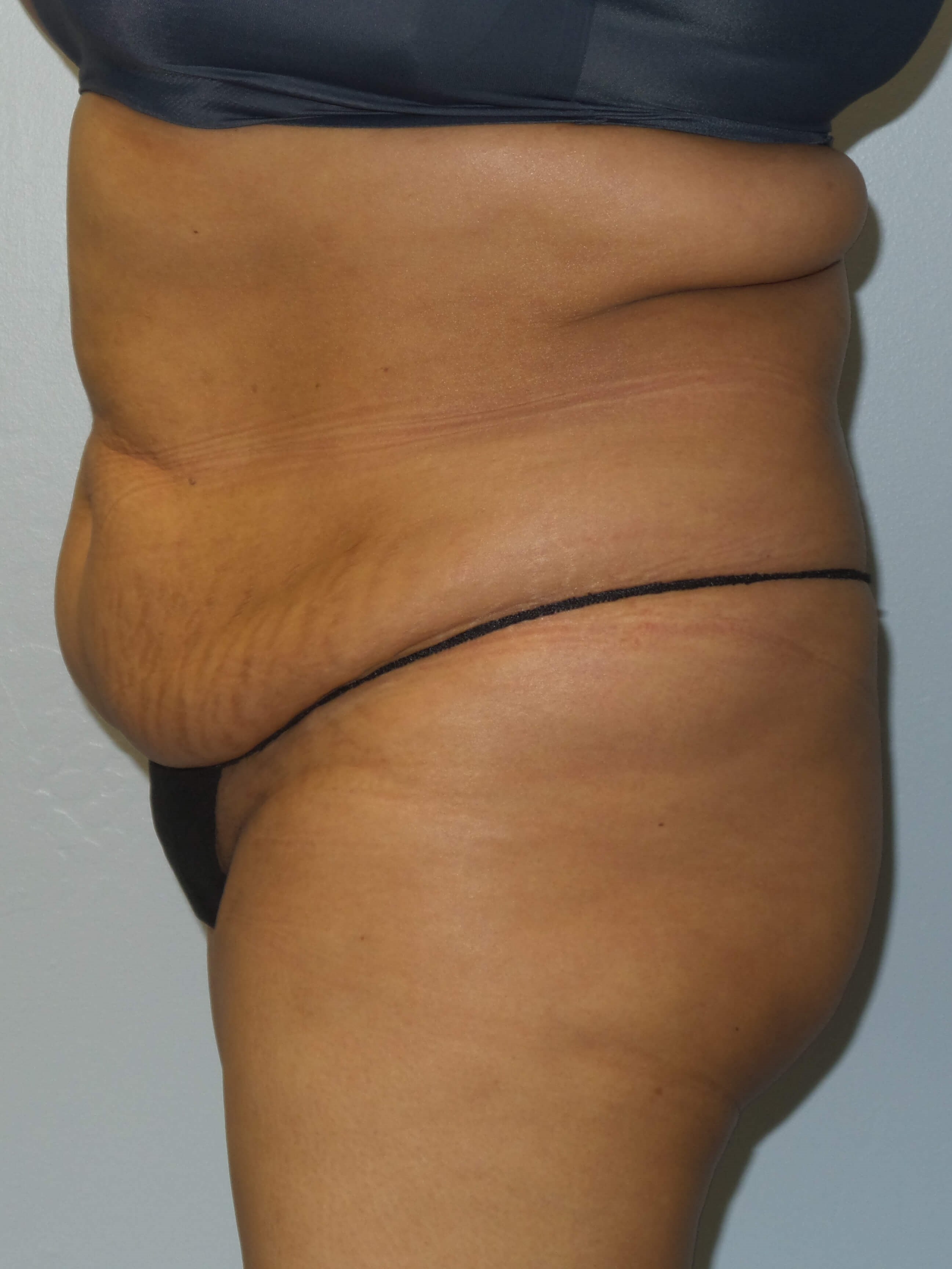 Woman Has Tummy Tuck Lipo Before