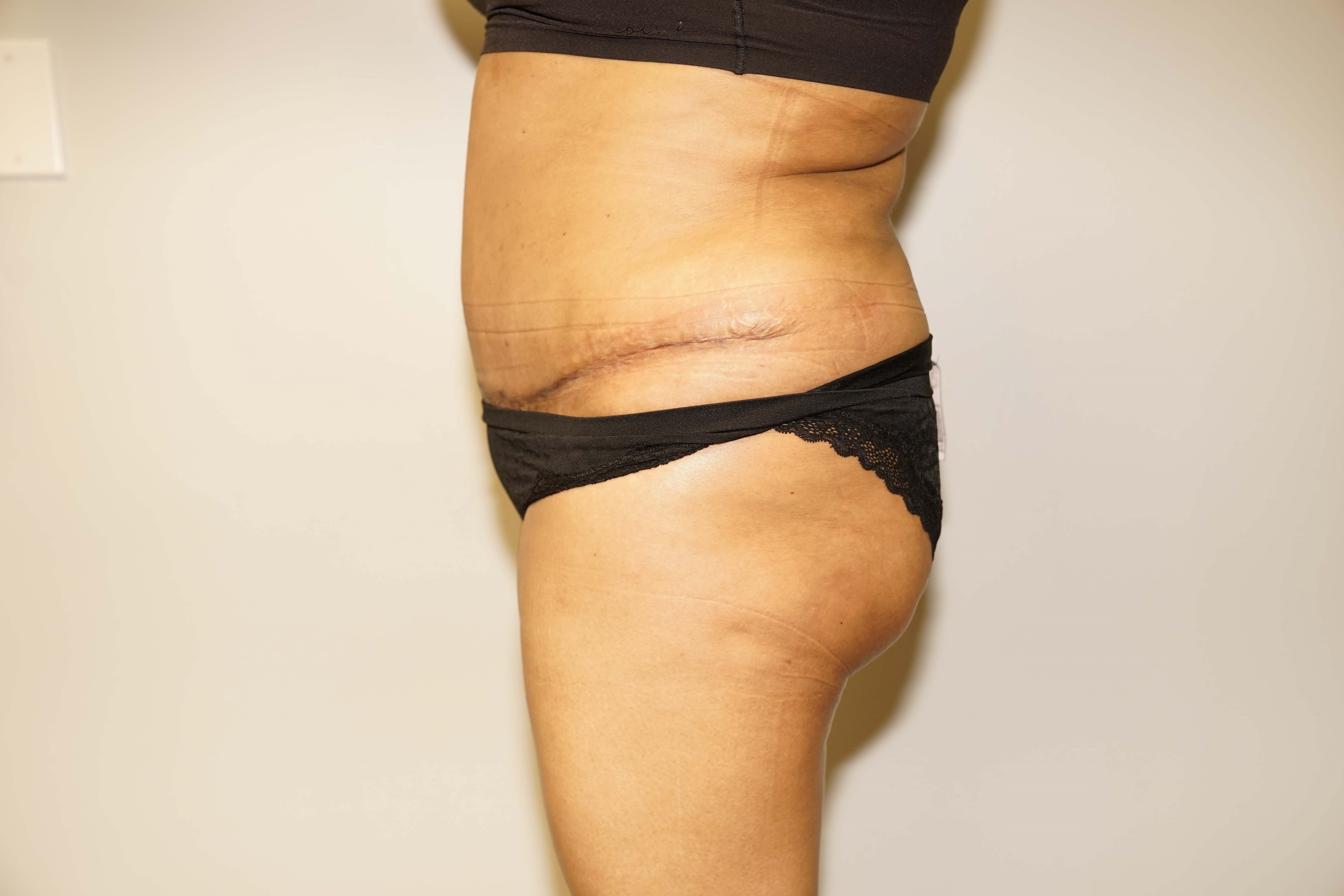 Woman Has Tummy Tuck Lipo After