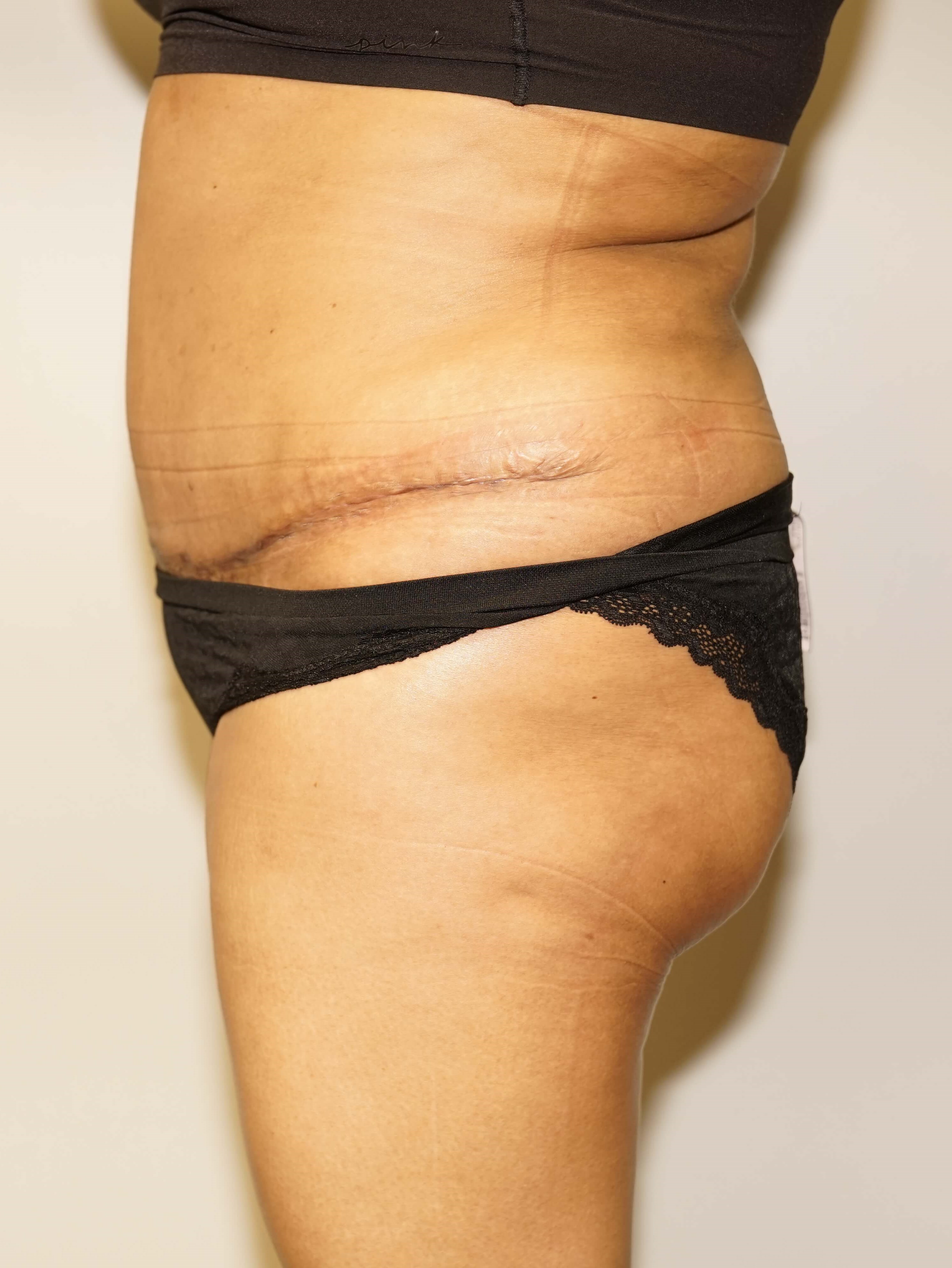Woman Has Tummy Tuck Lipo After