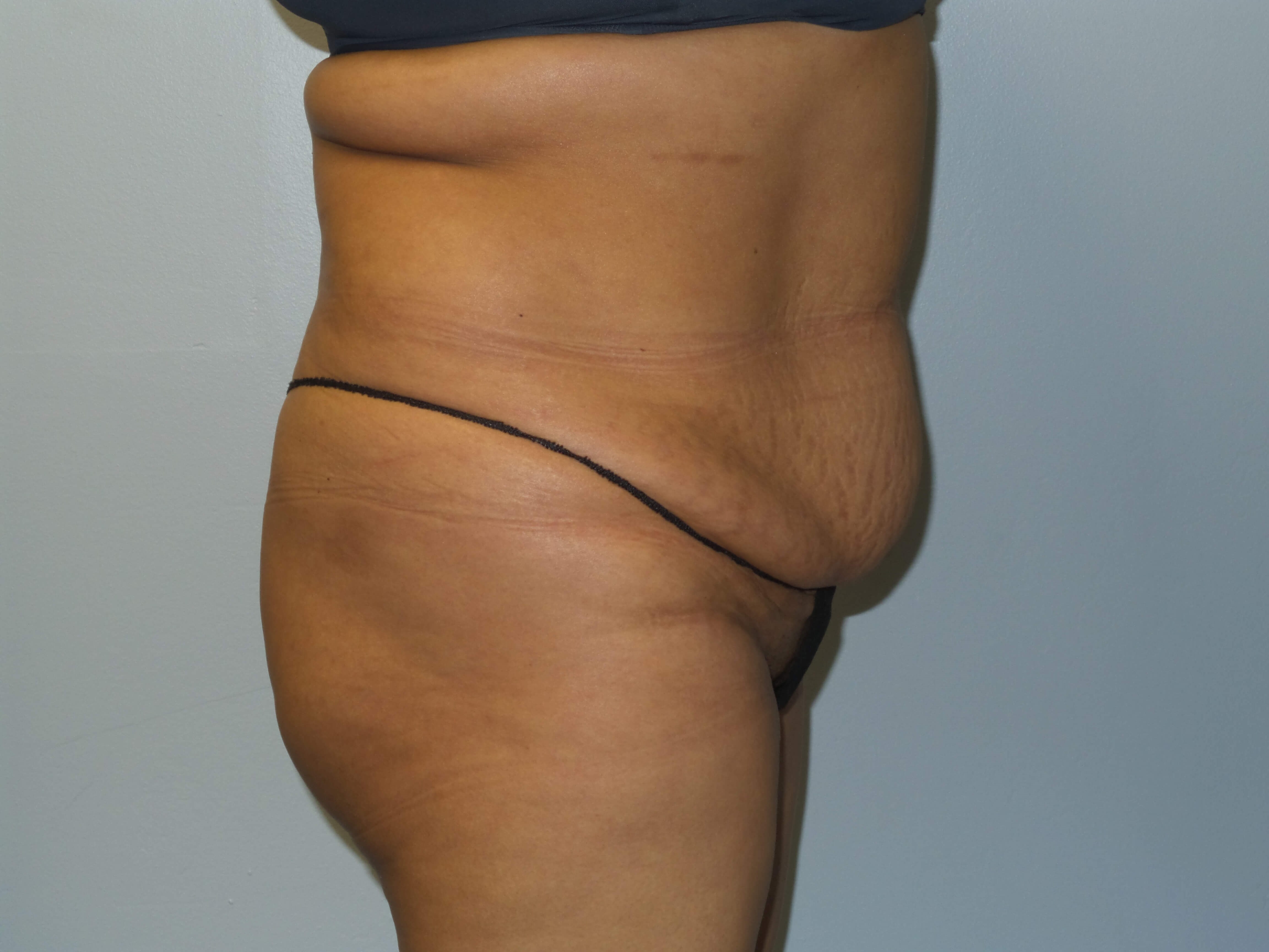 Woman Has Tummy Tuck Lipo Before