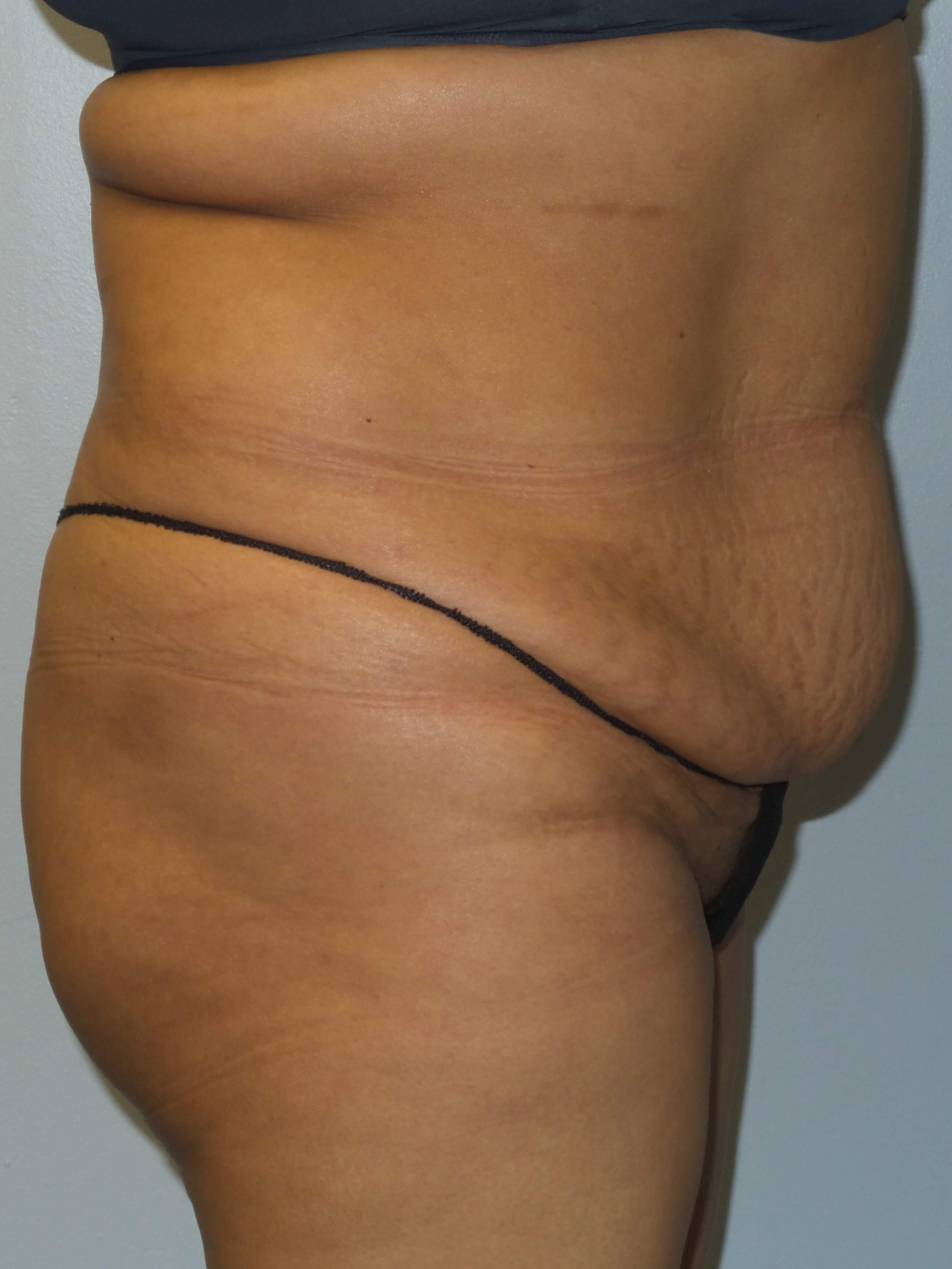 Woman Has Tummy Tuck Lipo Before