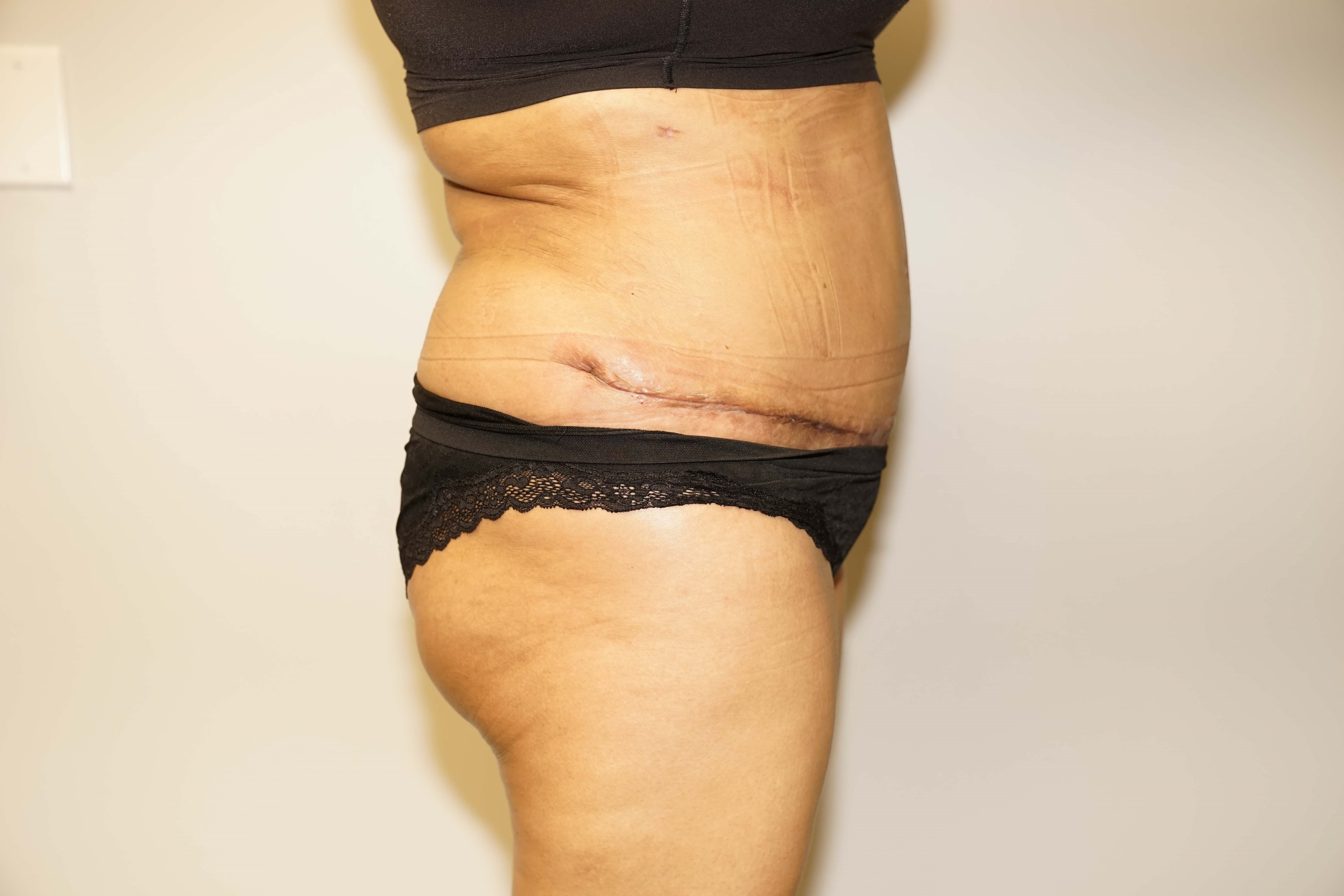 Woman Has Tummy Tuck Lipo After