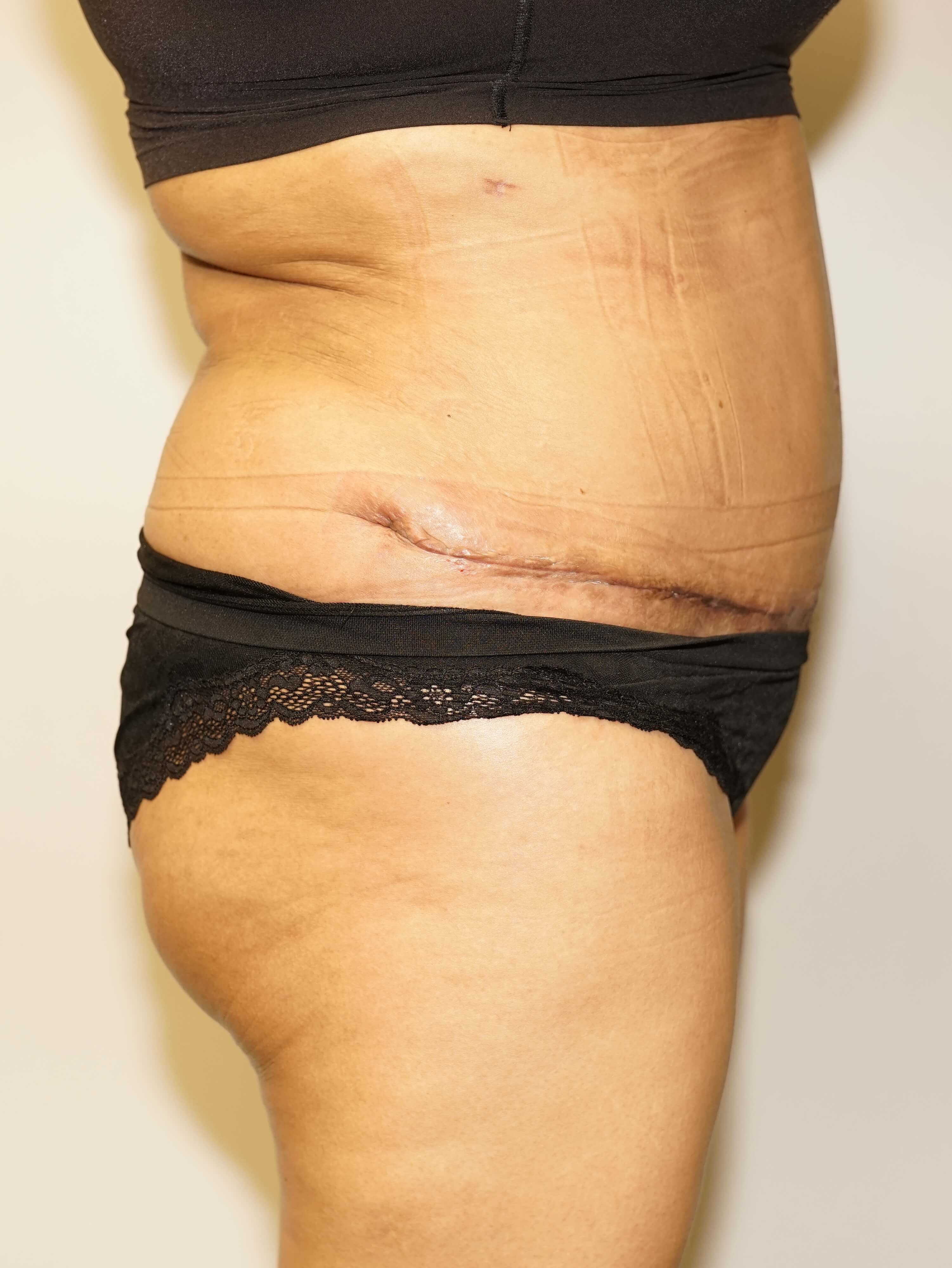 Woman Has Tummy Tuck Lipo After