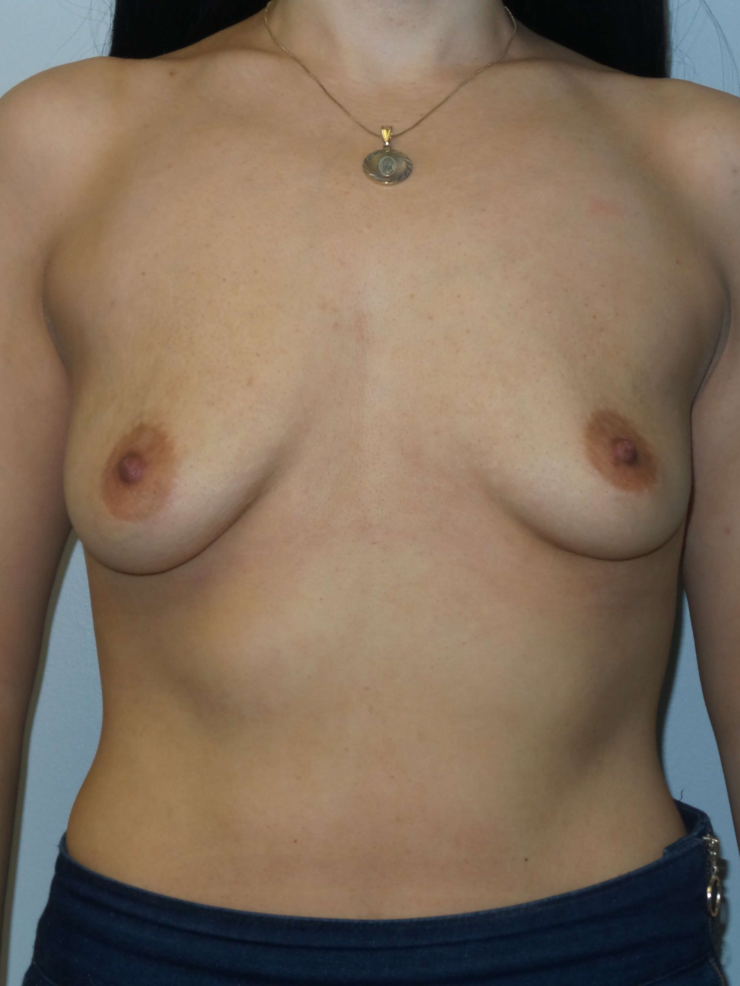 Westlake Woman Has Breast Aug Before
