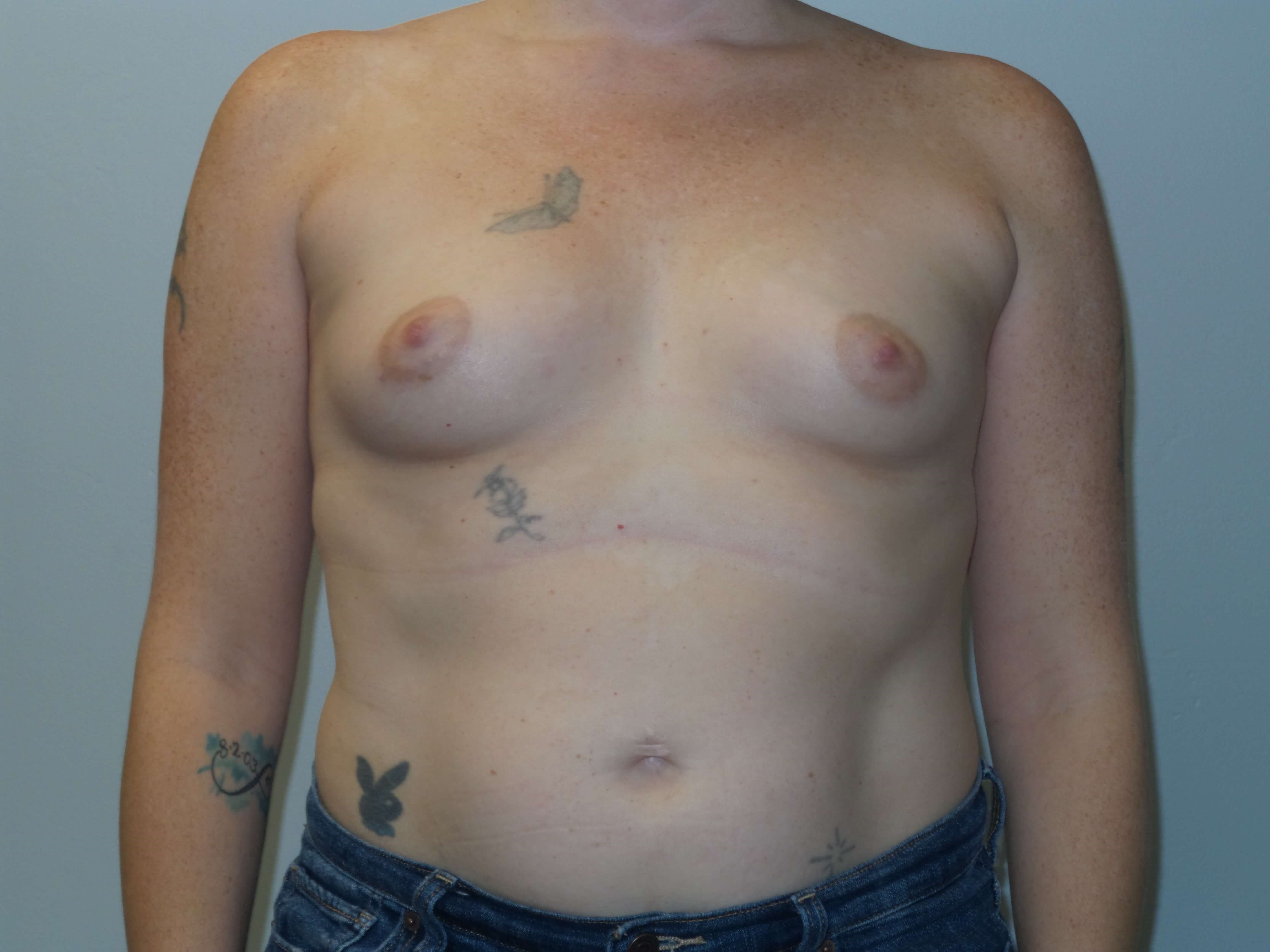 Westlake Woman Has Breast Aug Before