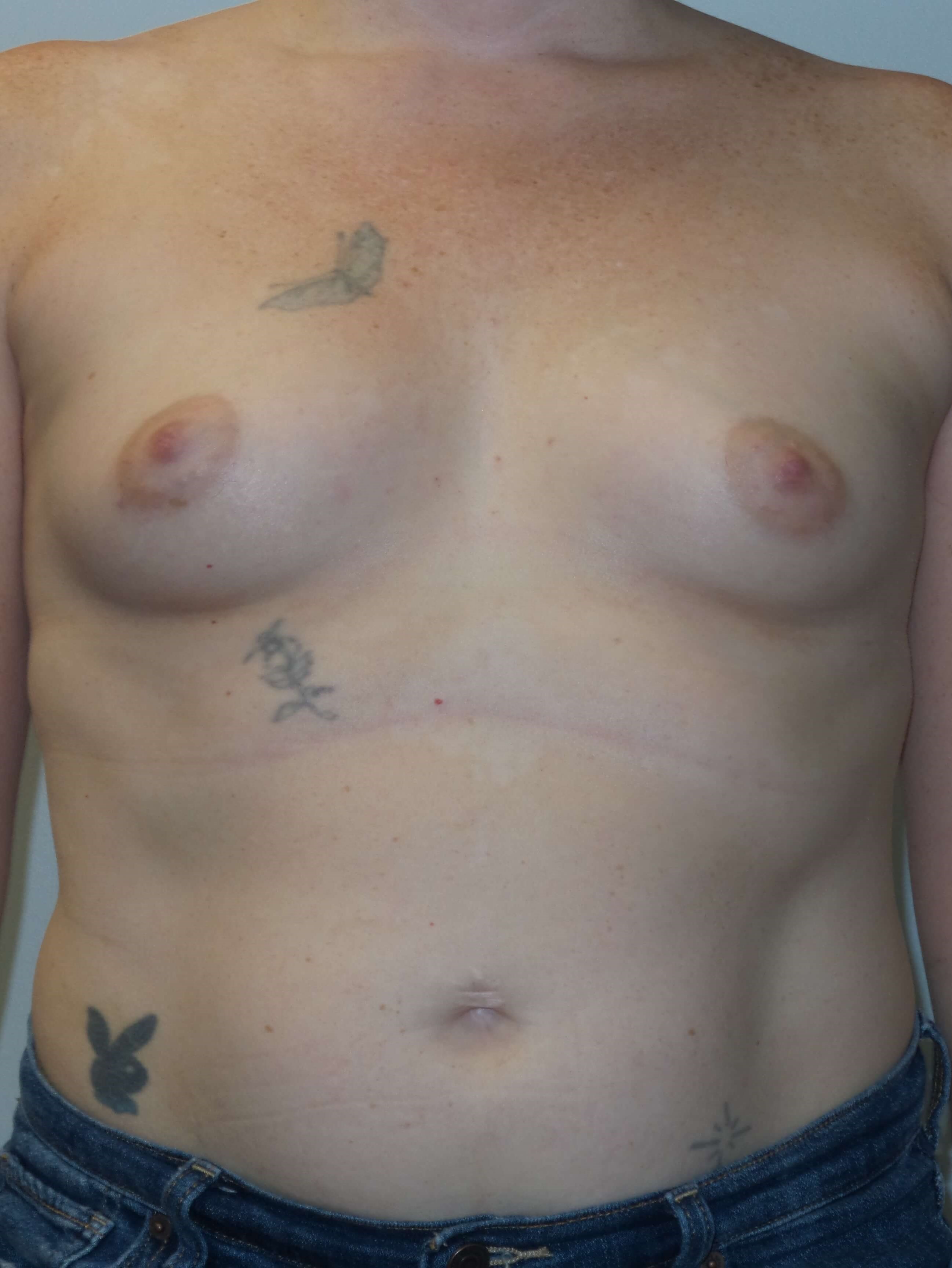 Westlake Woman Has Breast Aug Before