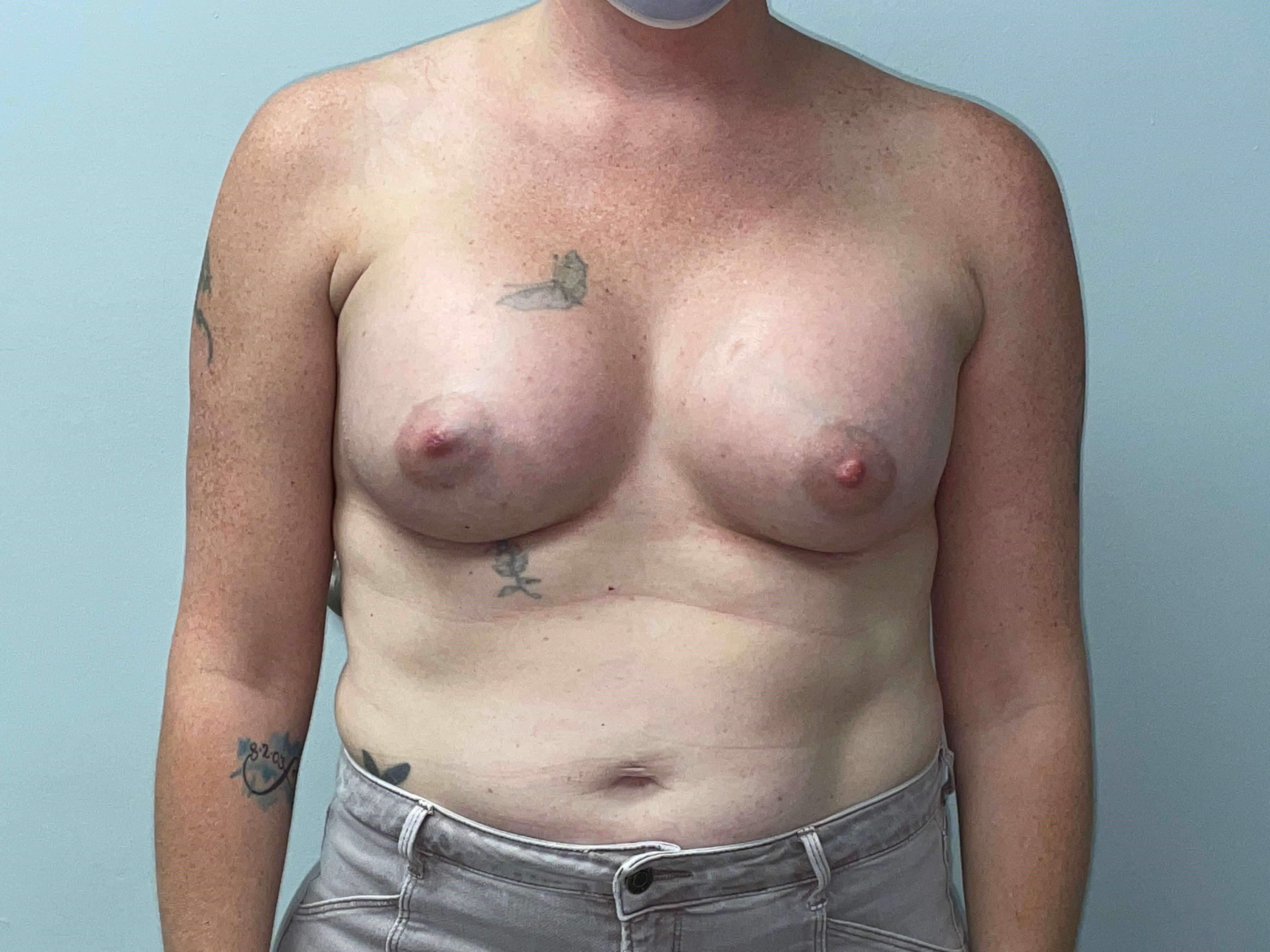 Westlake Woman Has Breast Aug After