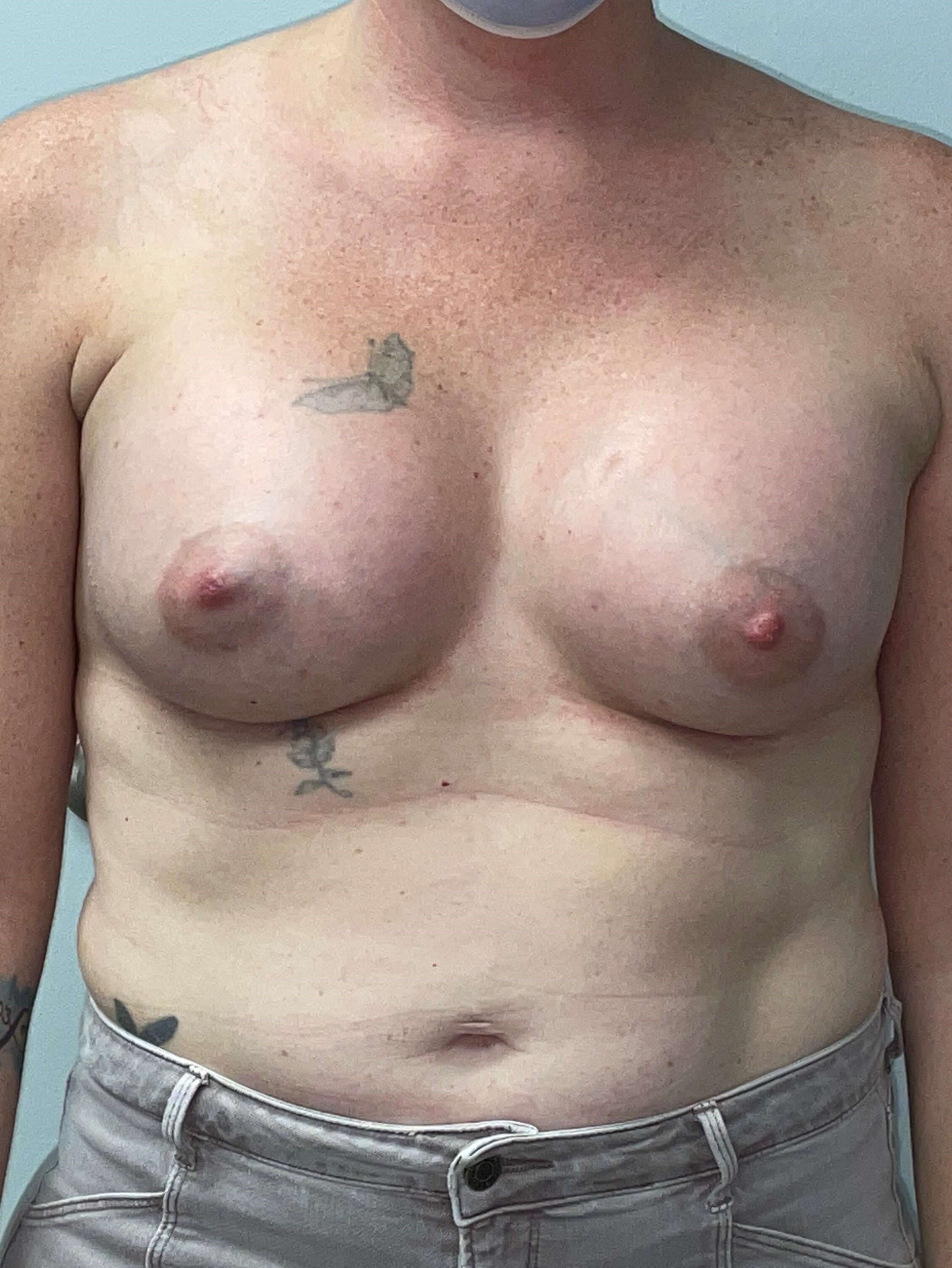 Westlake Woman Has Breast Aug After
