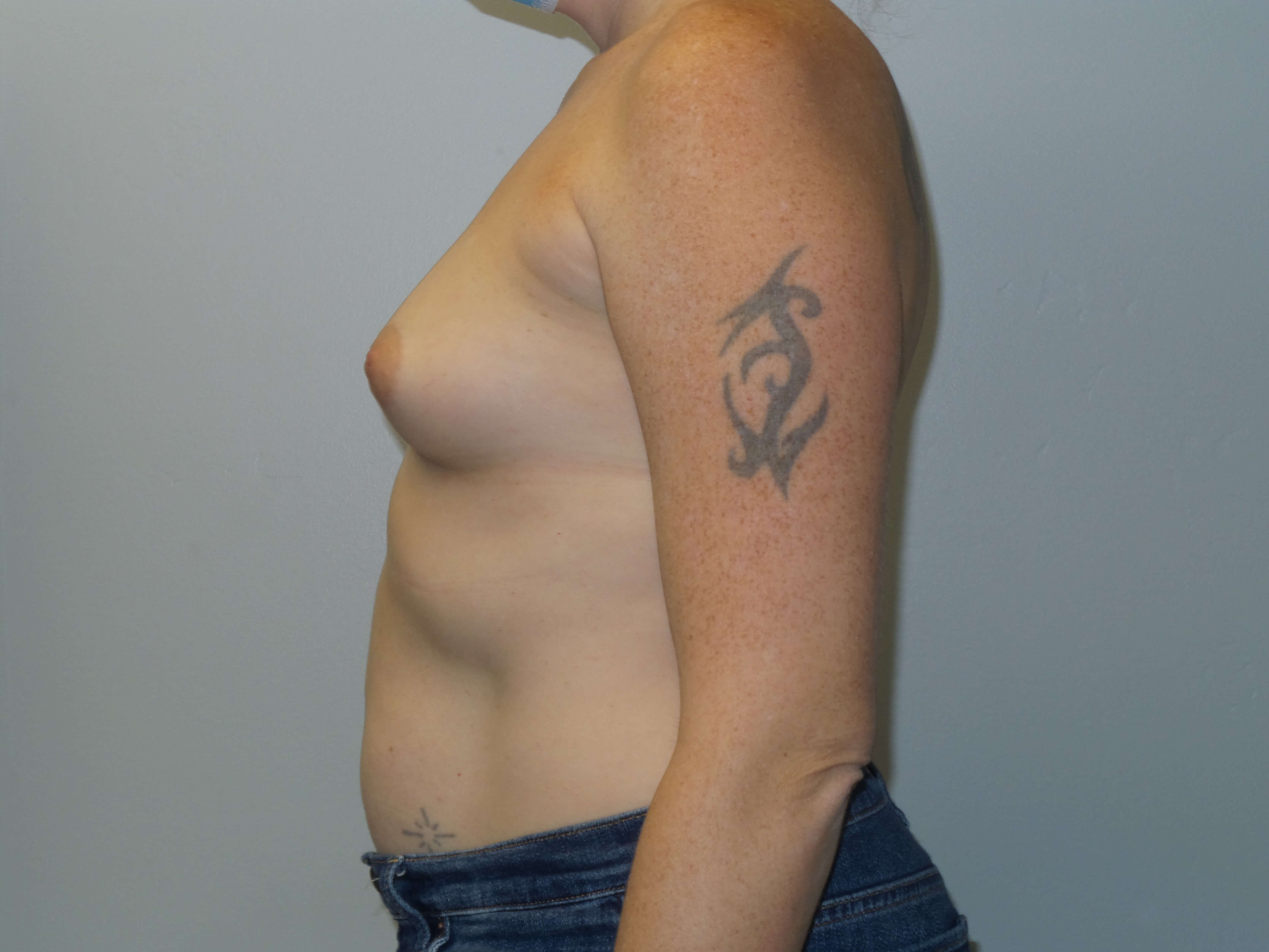 Westlake Woman Has Breast Aug Before