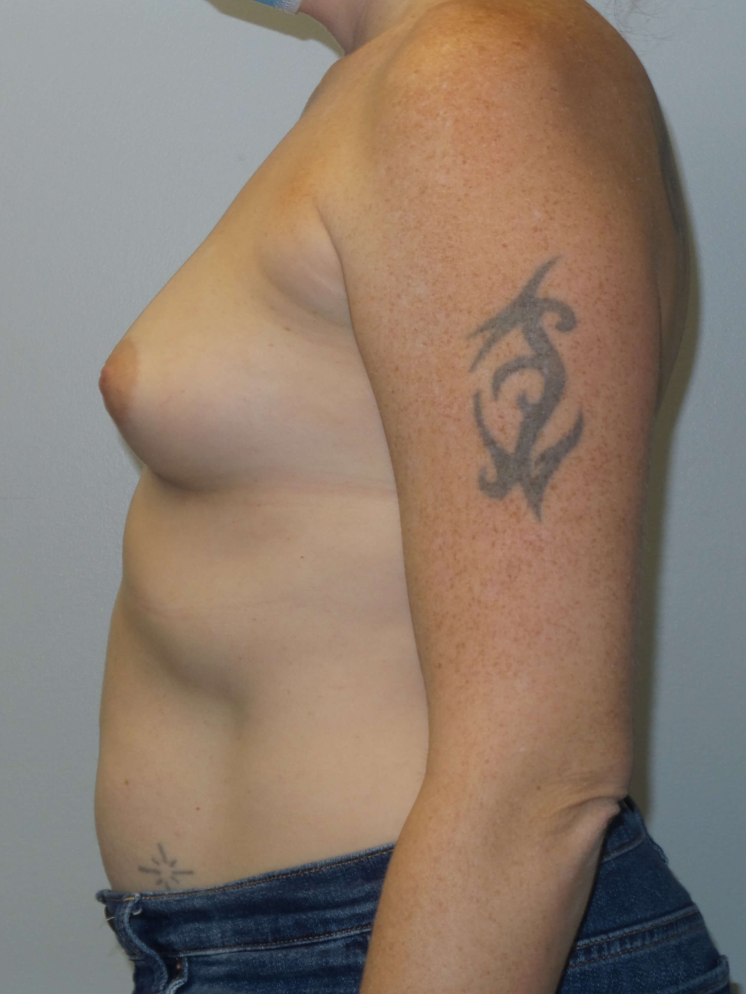 Westlake Woman Has Breast Aug Before