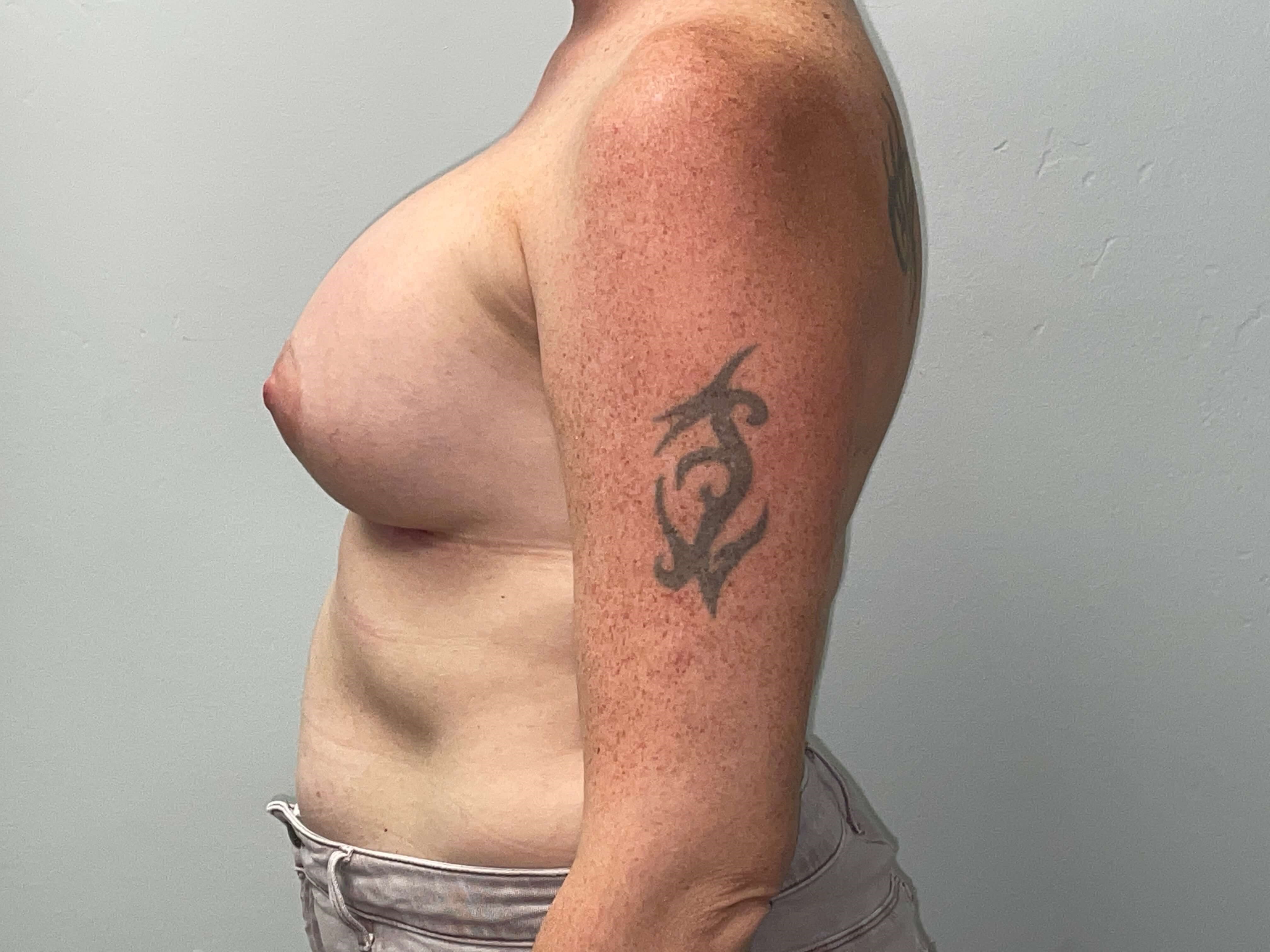 Westlake Woman Has Breast Aug After