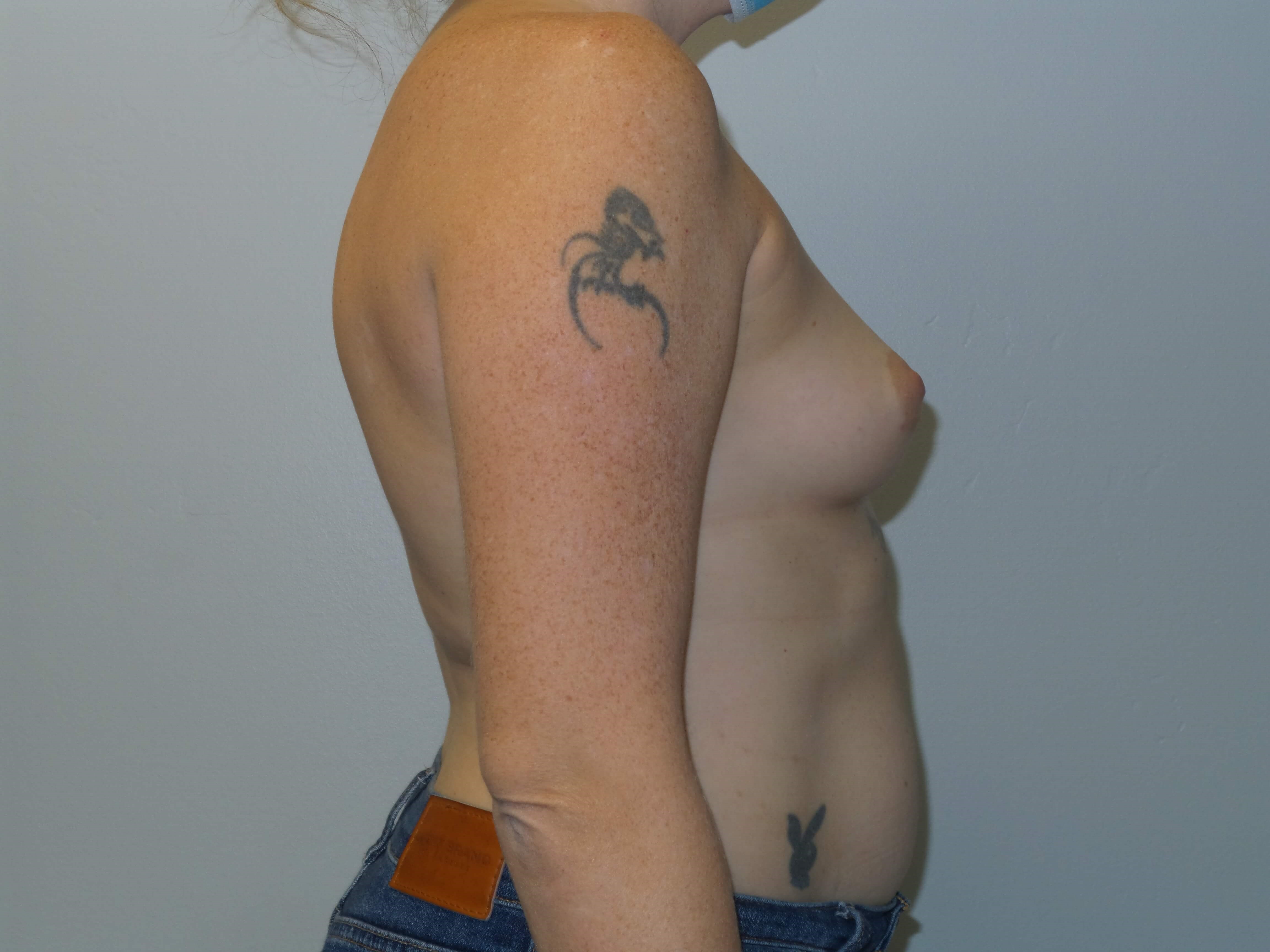 Westlake Woman Has Breast Aug Before