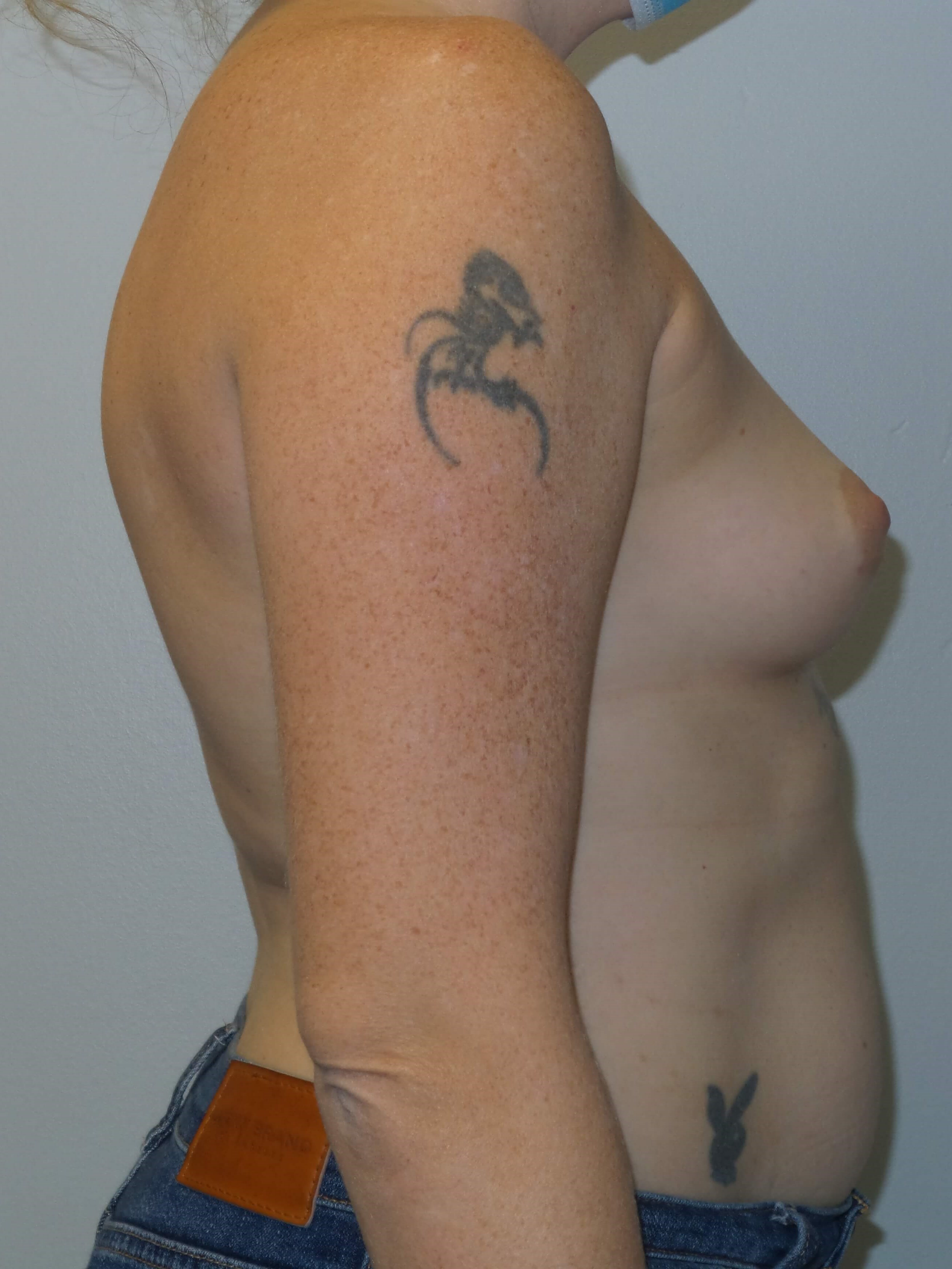 Westlake Woman Has Breast Aug Before