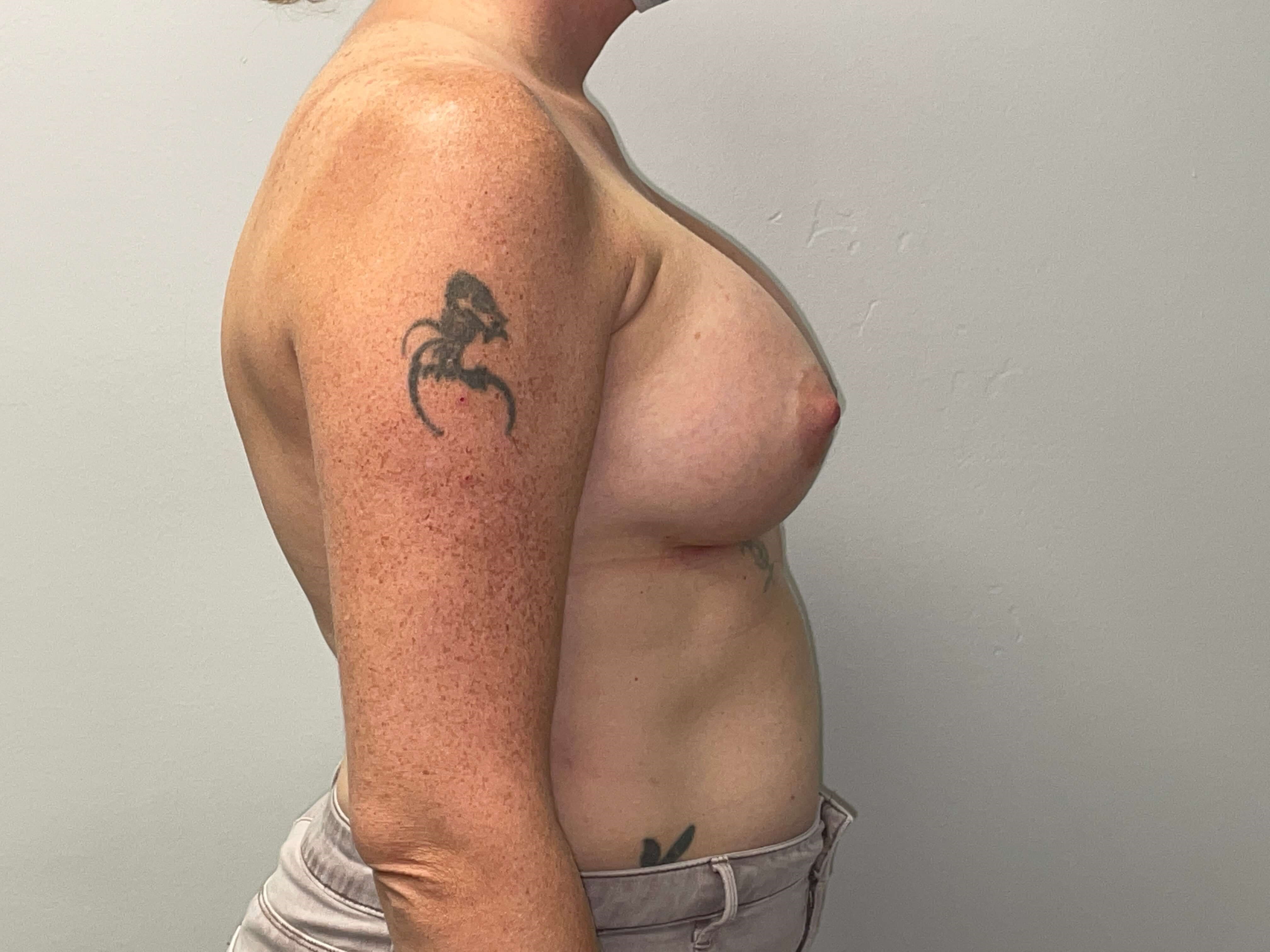 Westlake Woman Has Breast Aug After