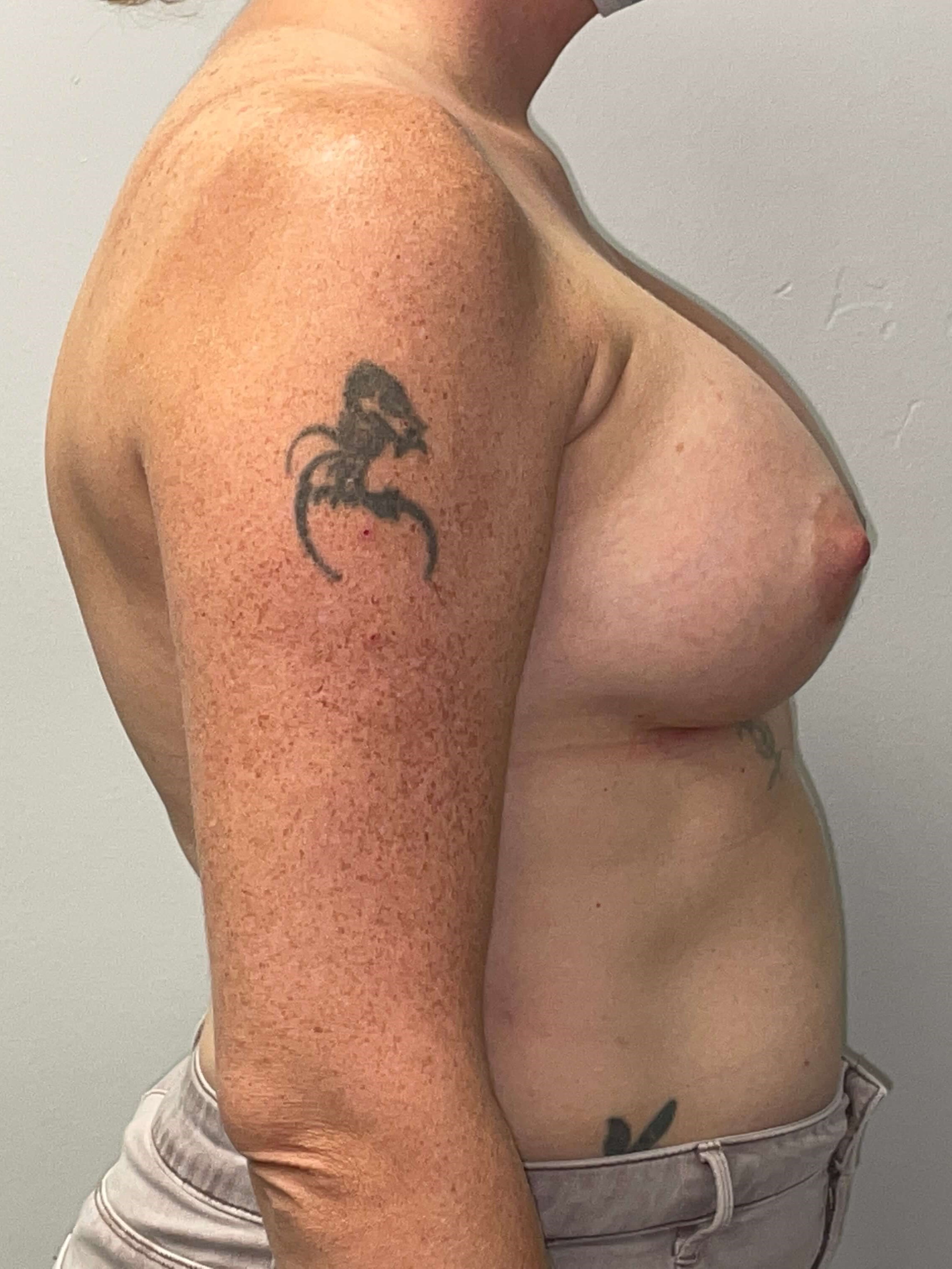 Westlake Woman Has Breast Aug After
