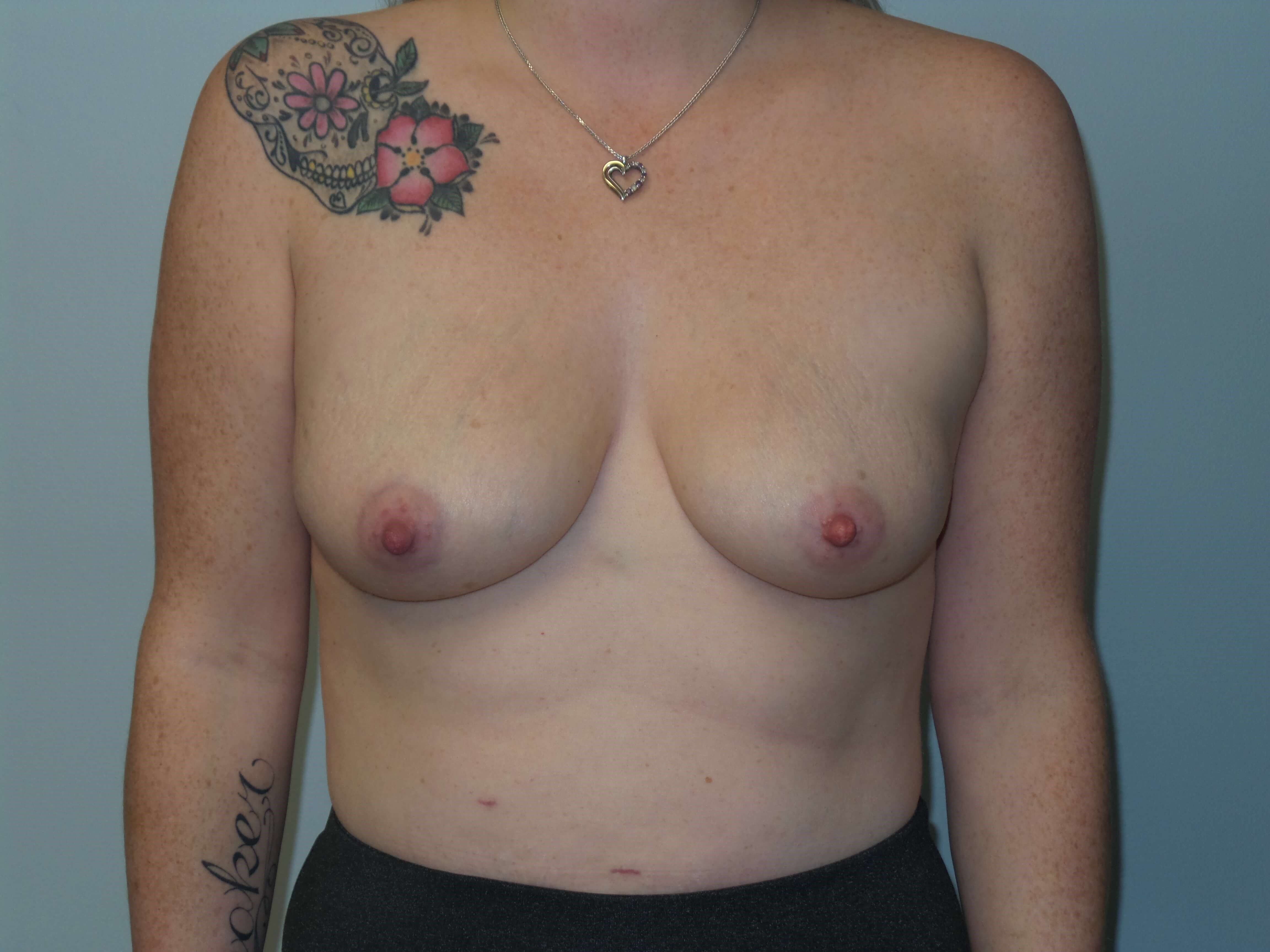 Westlake Woman Has Breast Aug Before
