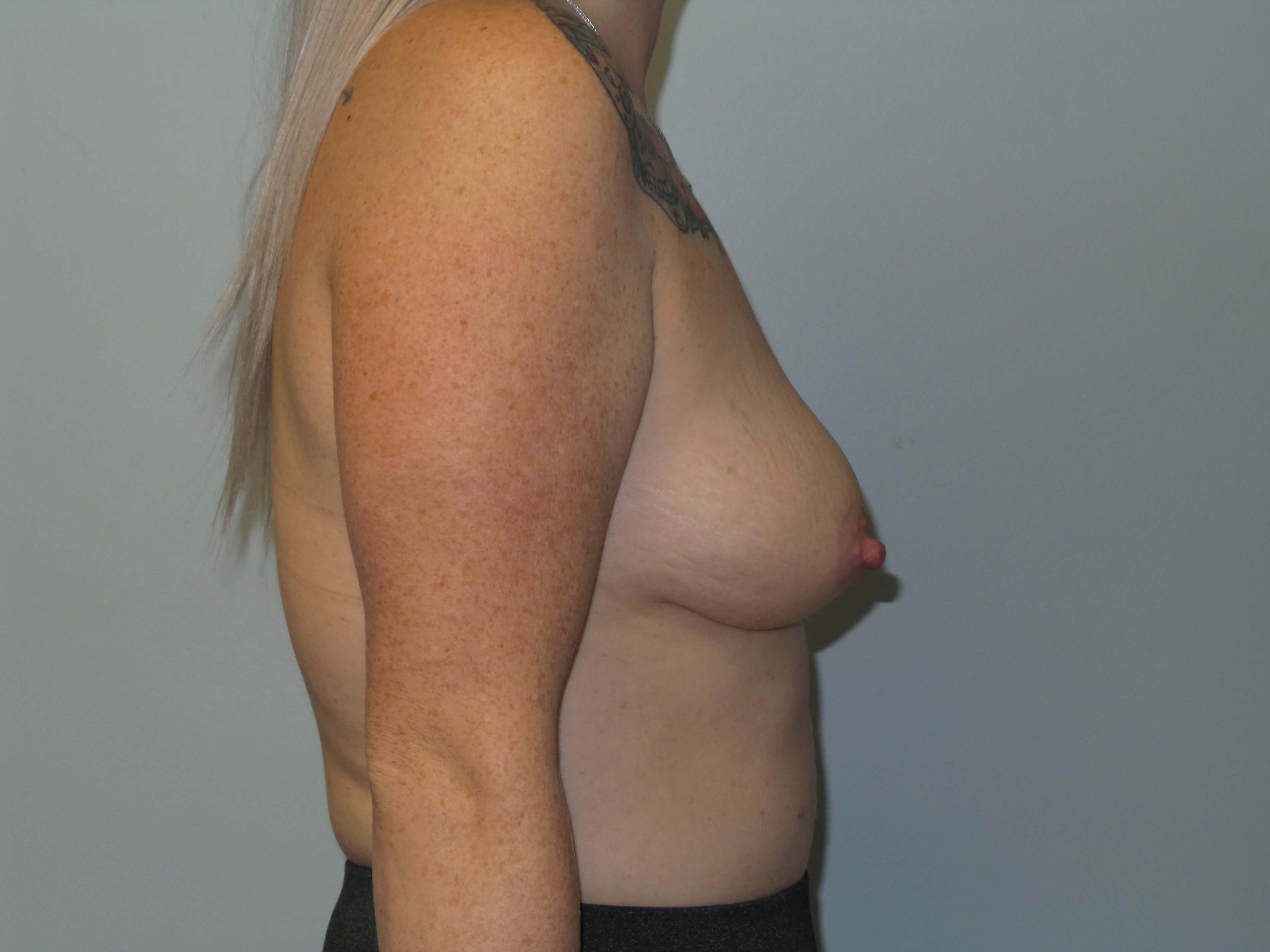 Westlake Woman Has Breast Aug Before