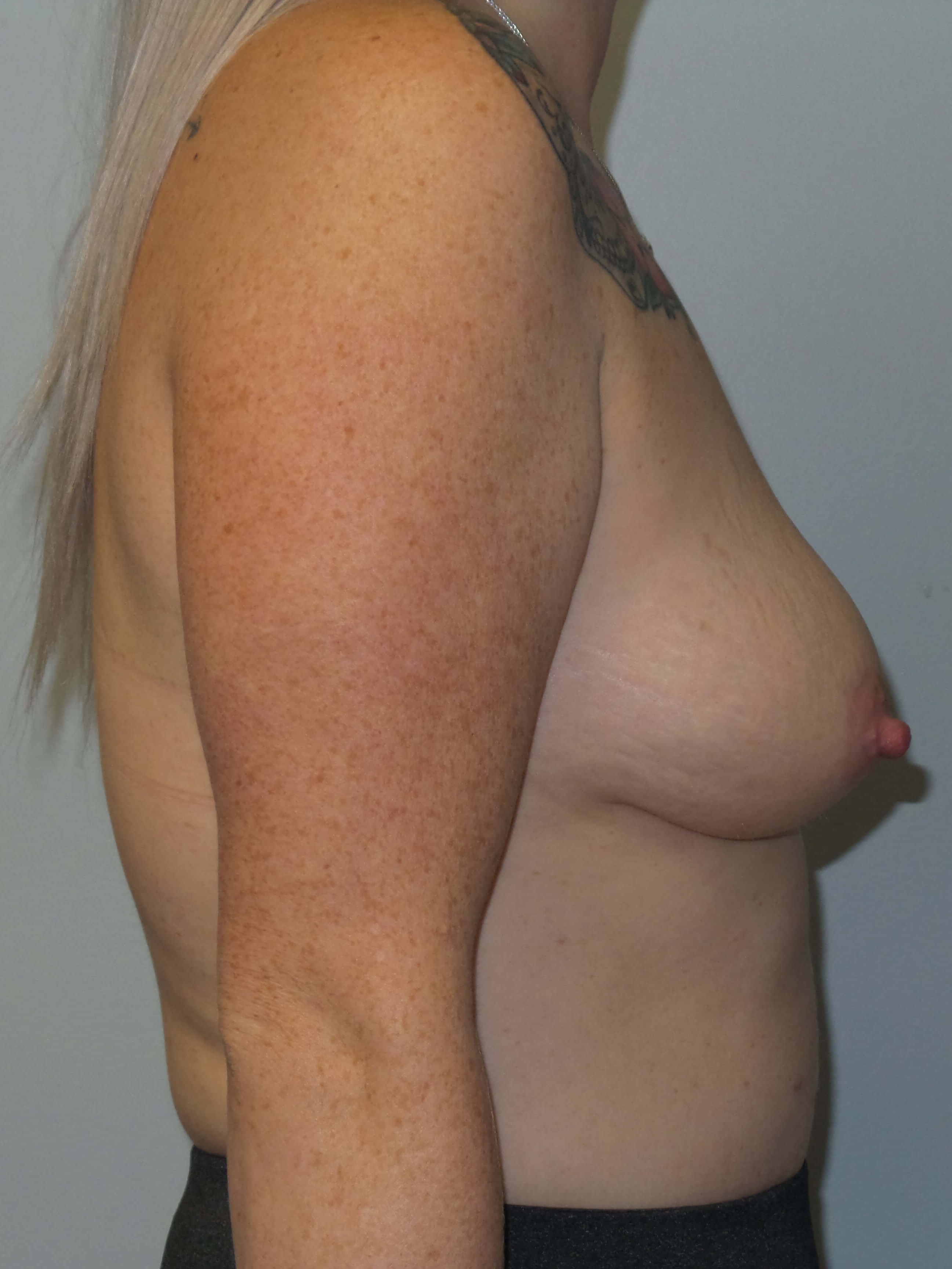 Westlake Woman Has Breast Aug Before