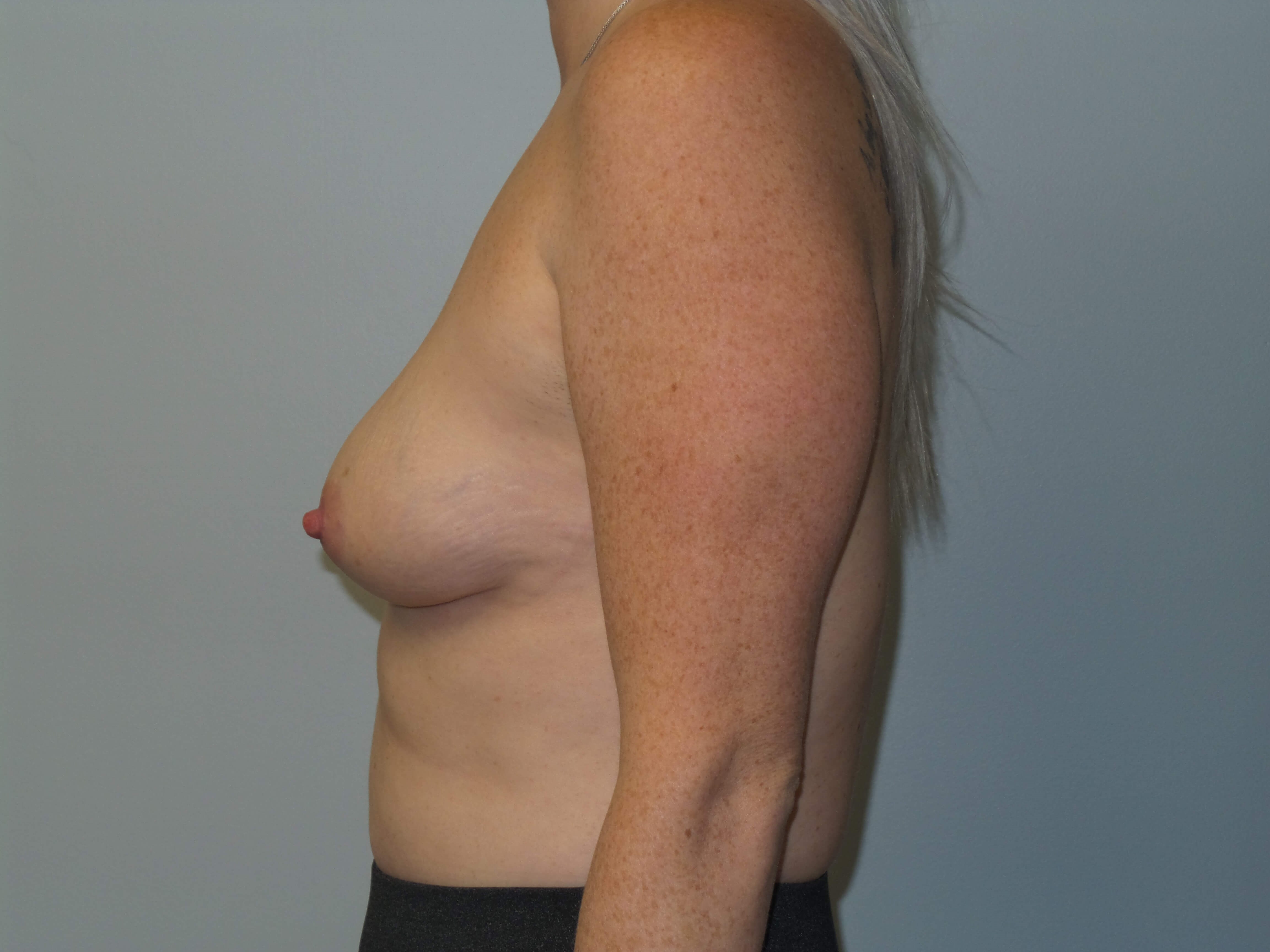 Westlake Woman Has Breast Aug Before