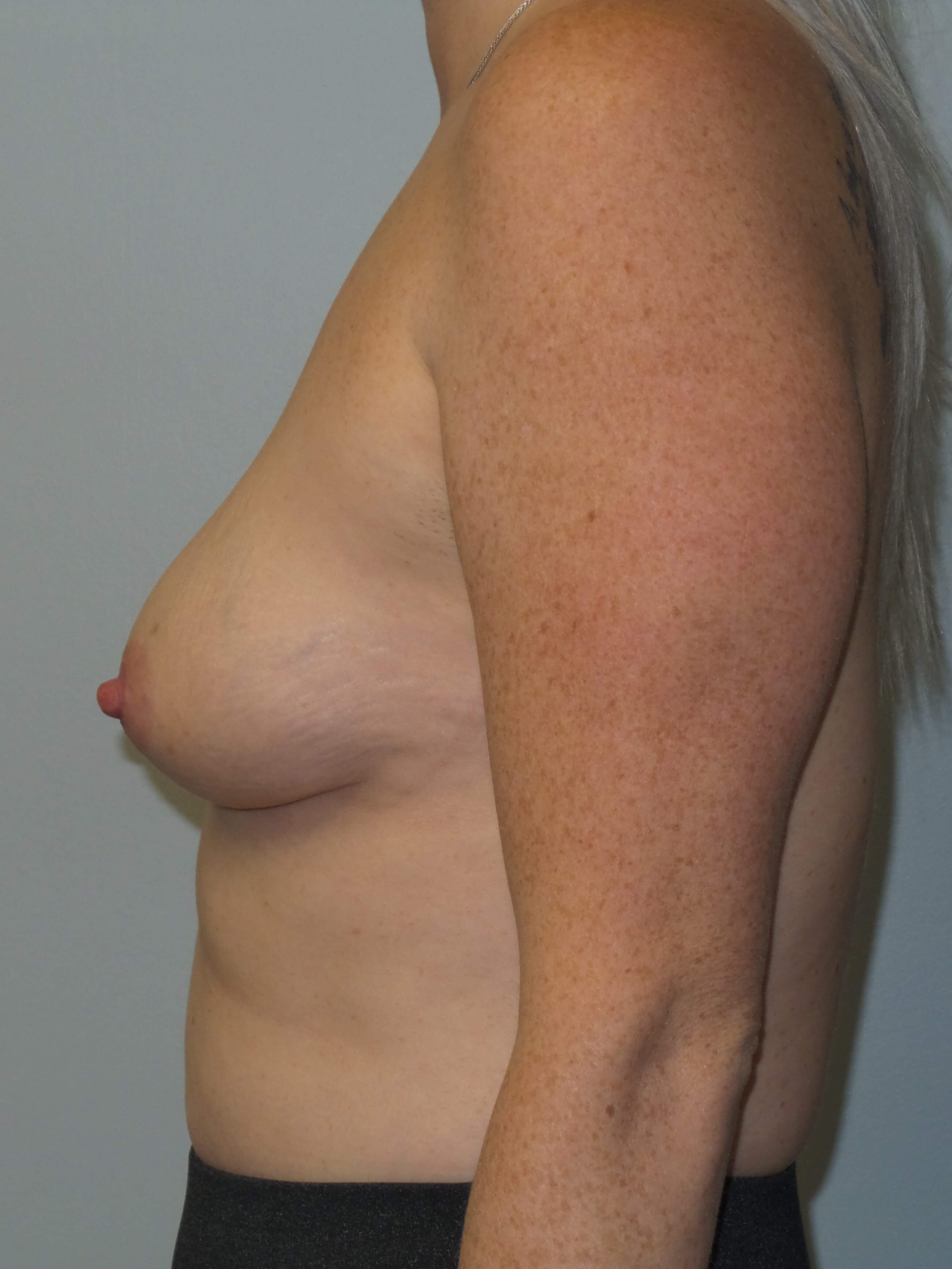 Westlake Woman Has Breast Aug Before