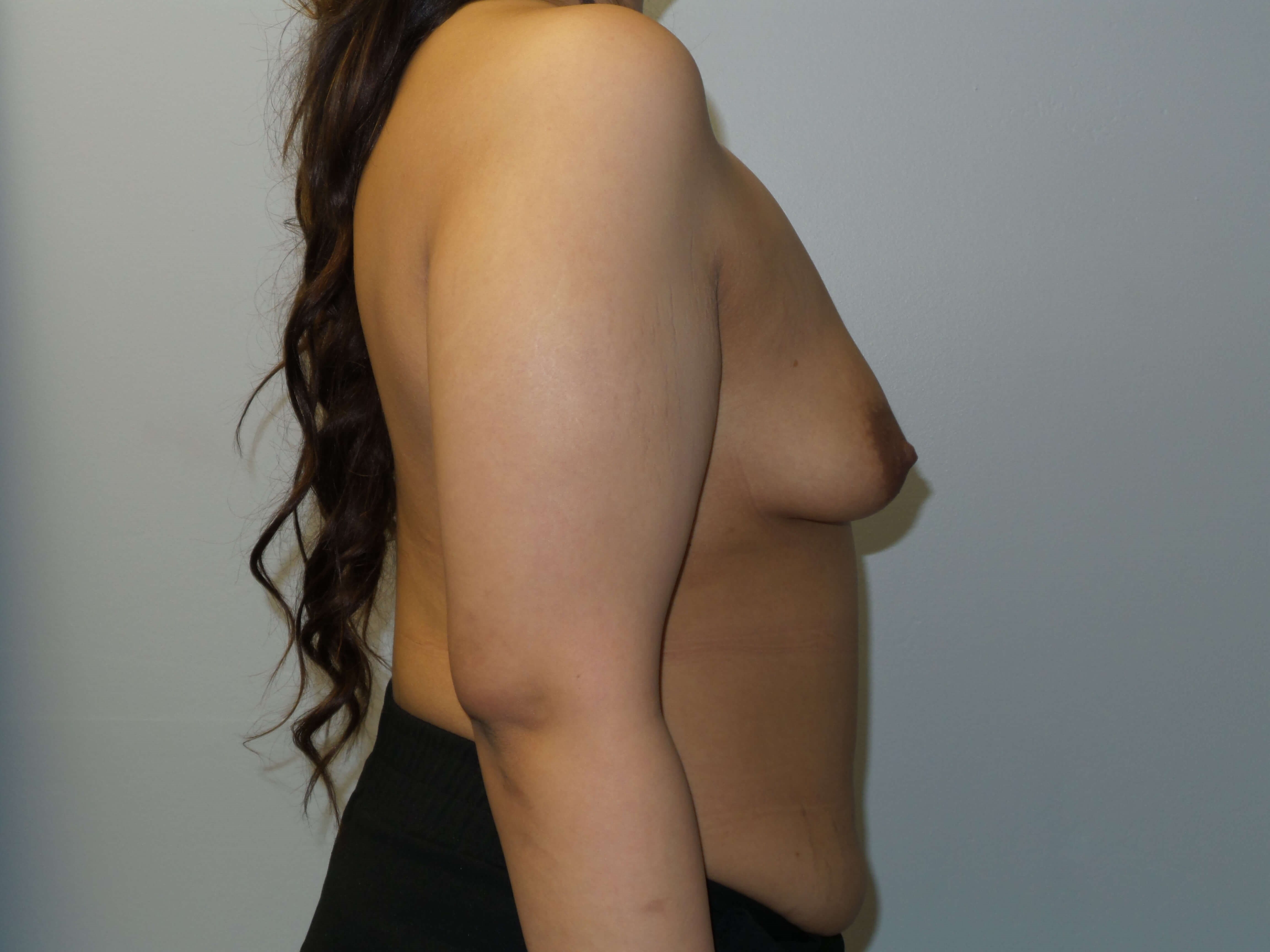 Tuberous breast gets implants Before