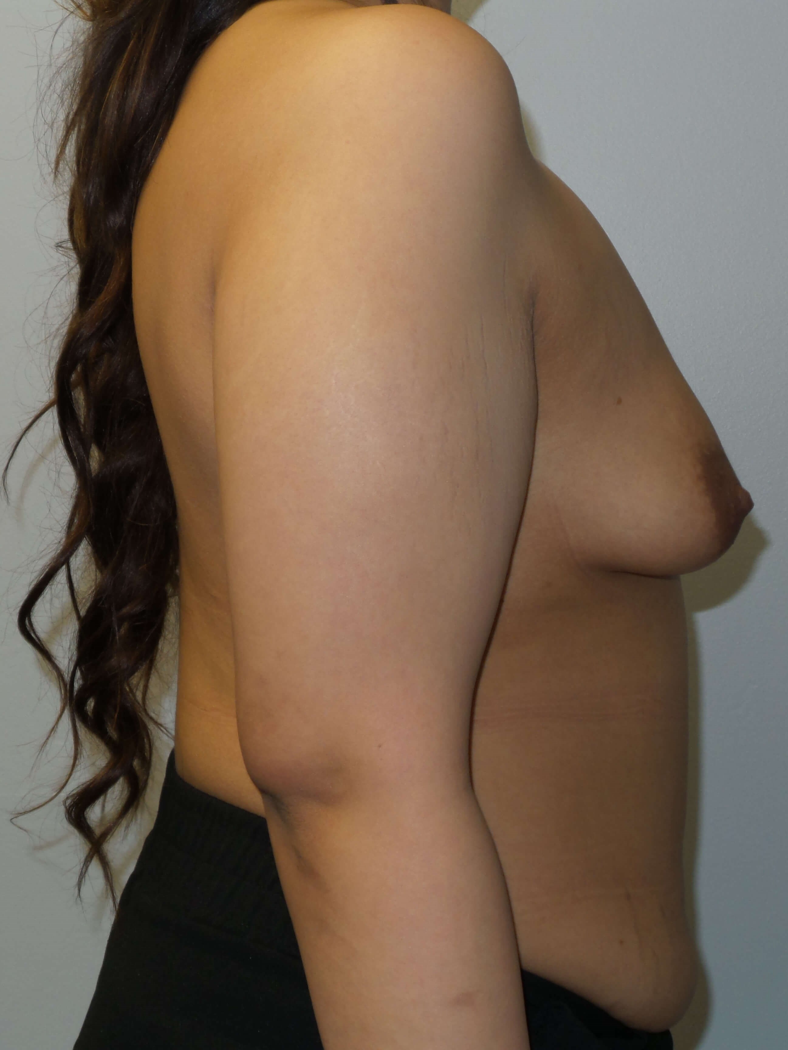 Tuberous breast gets implants Before