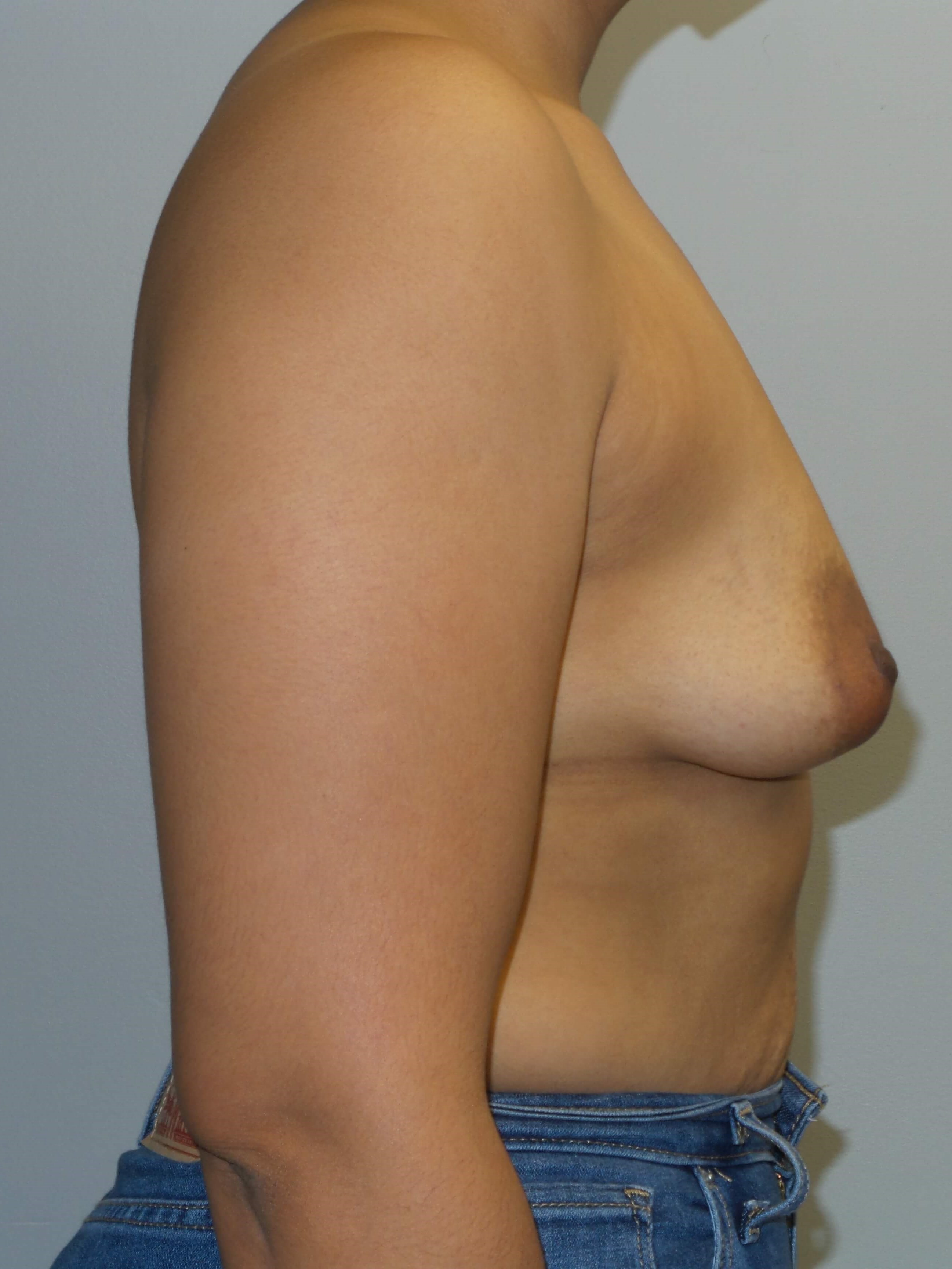 Westlake Woman Has Breast Aug Before
