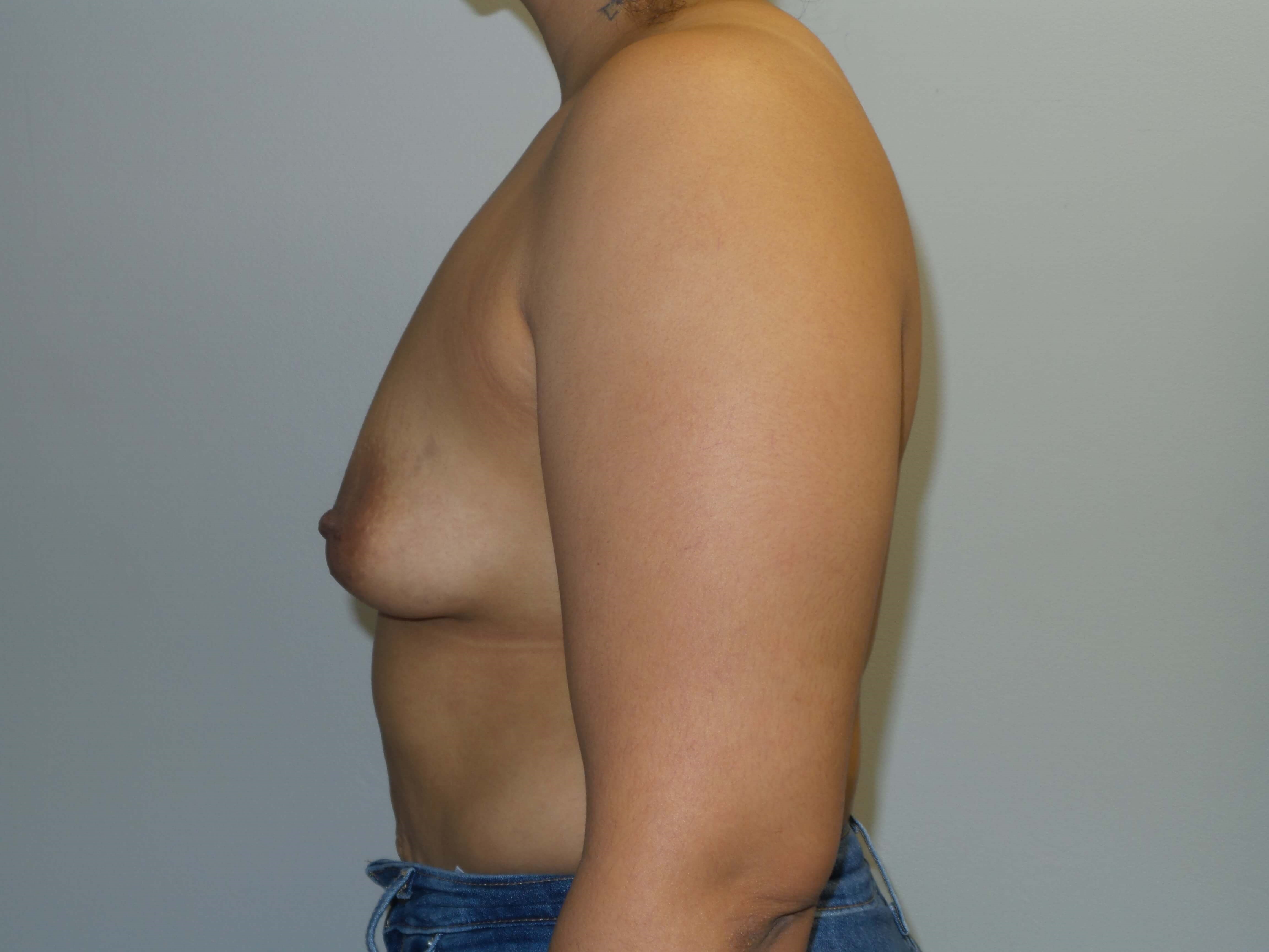 Westlake Woman Has Breast Aug Before