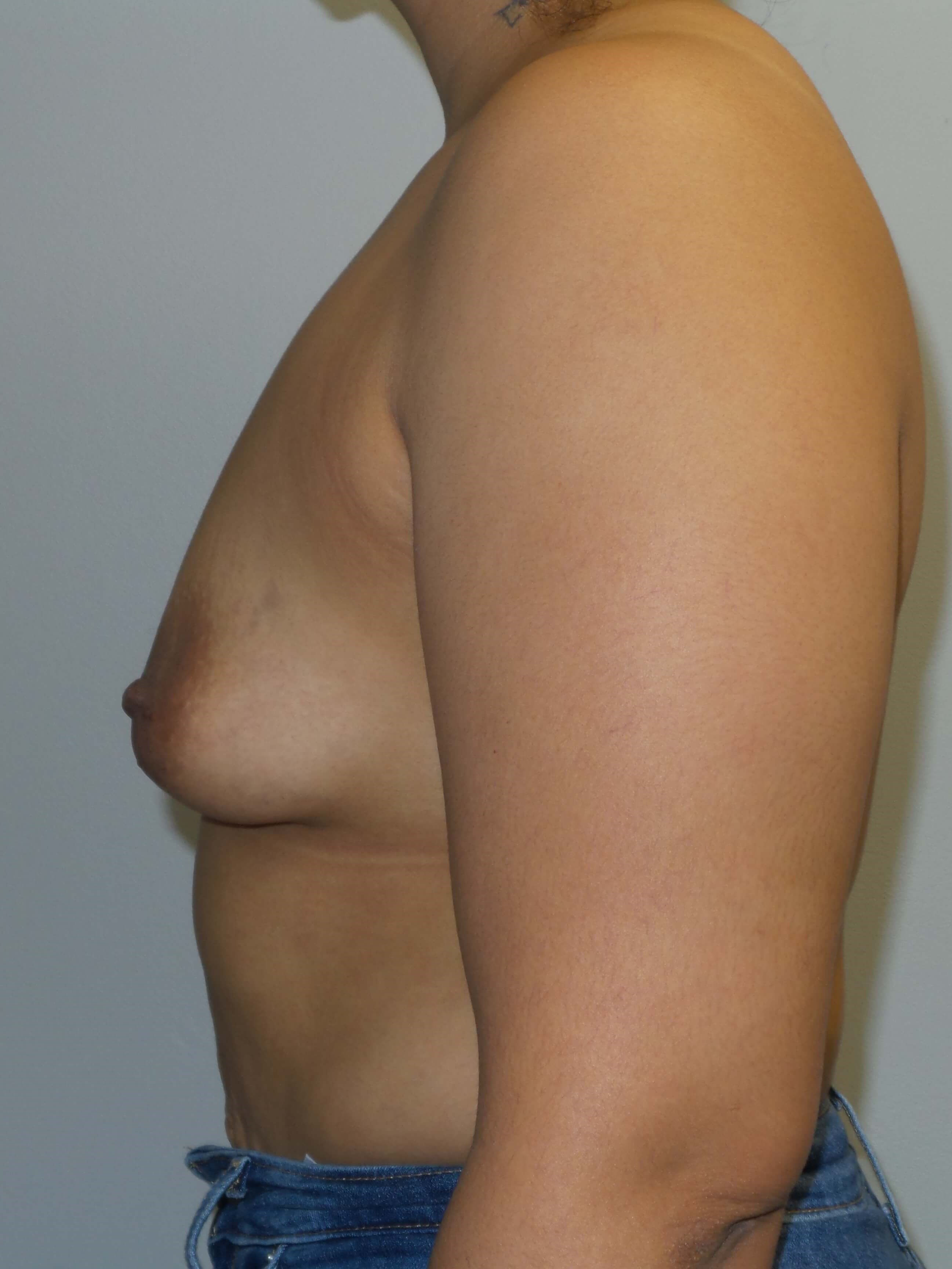 Westlake Woman Has Breast Aug Before