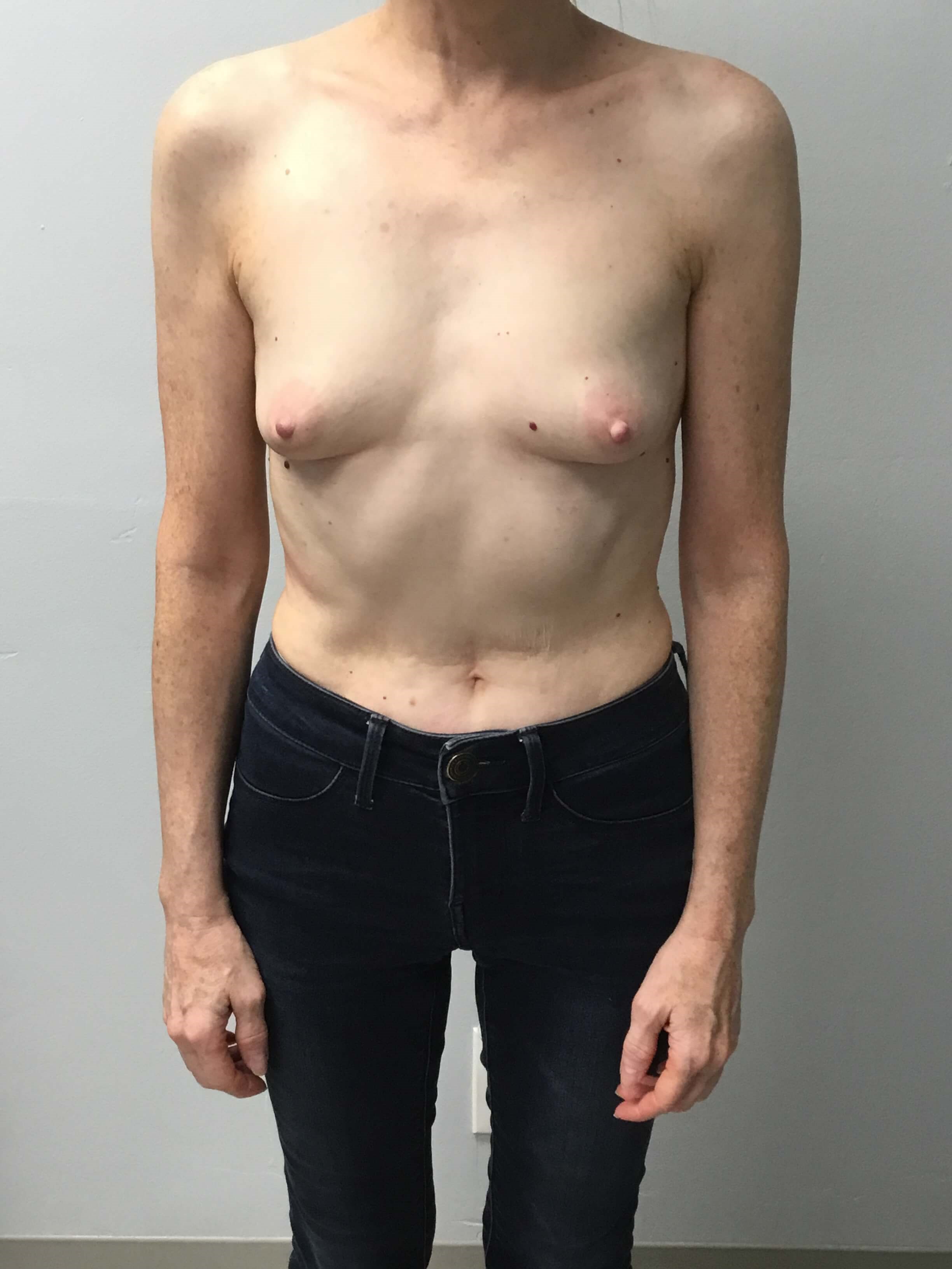 Westlake Woman Has Breast Aug Before