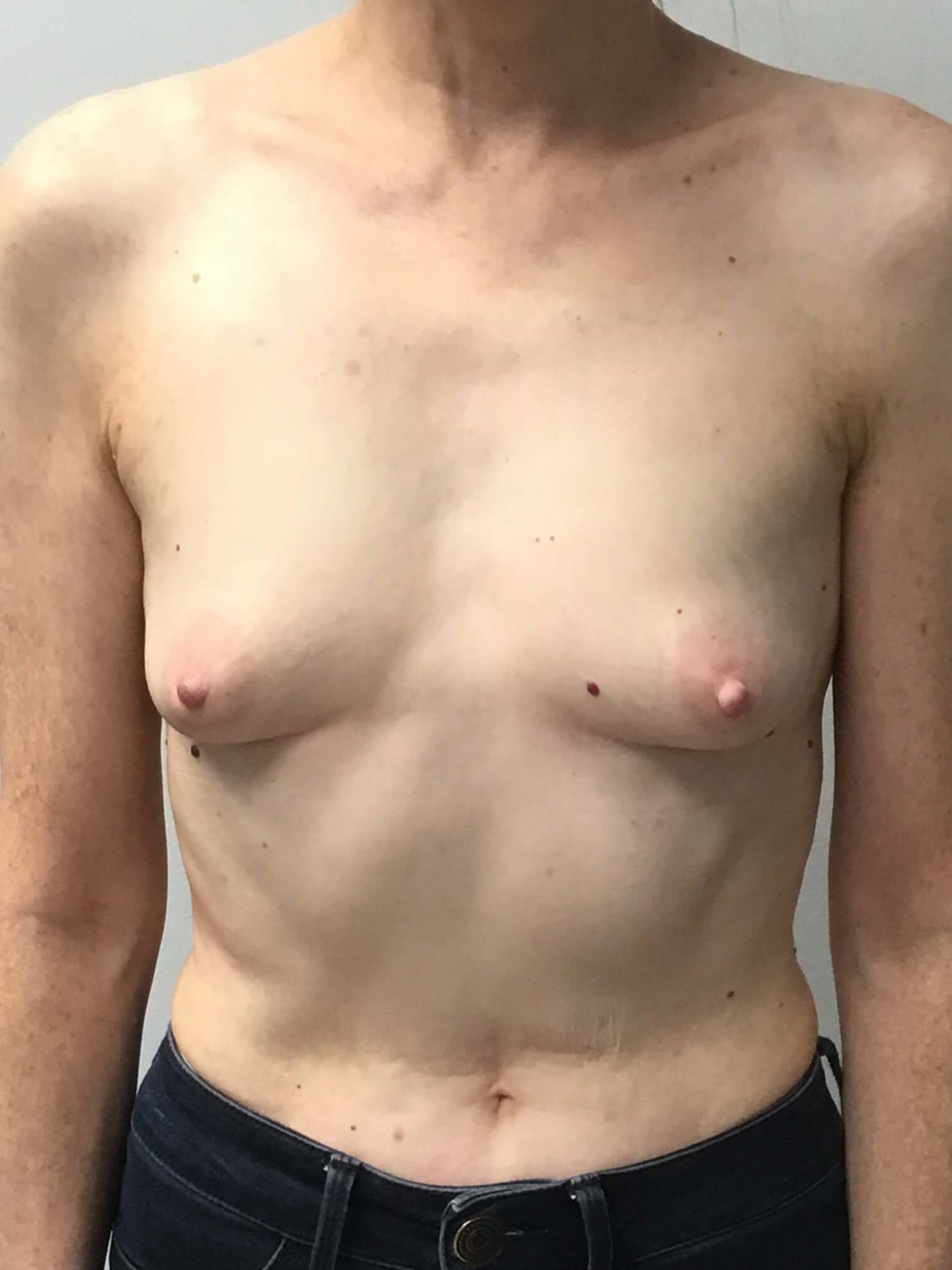 Westlake Woman Has Breast Aug Before