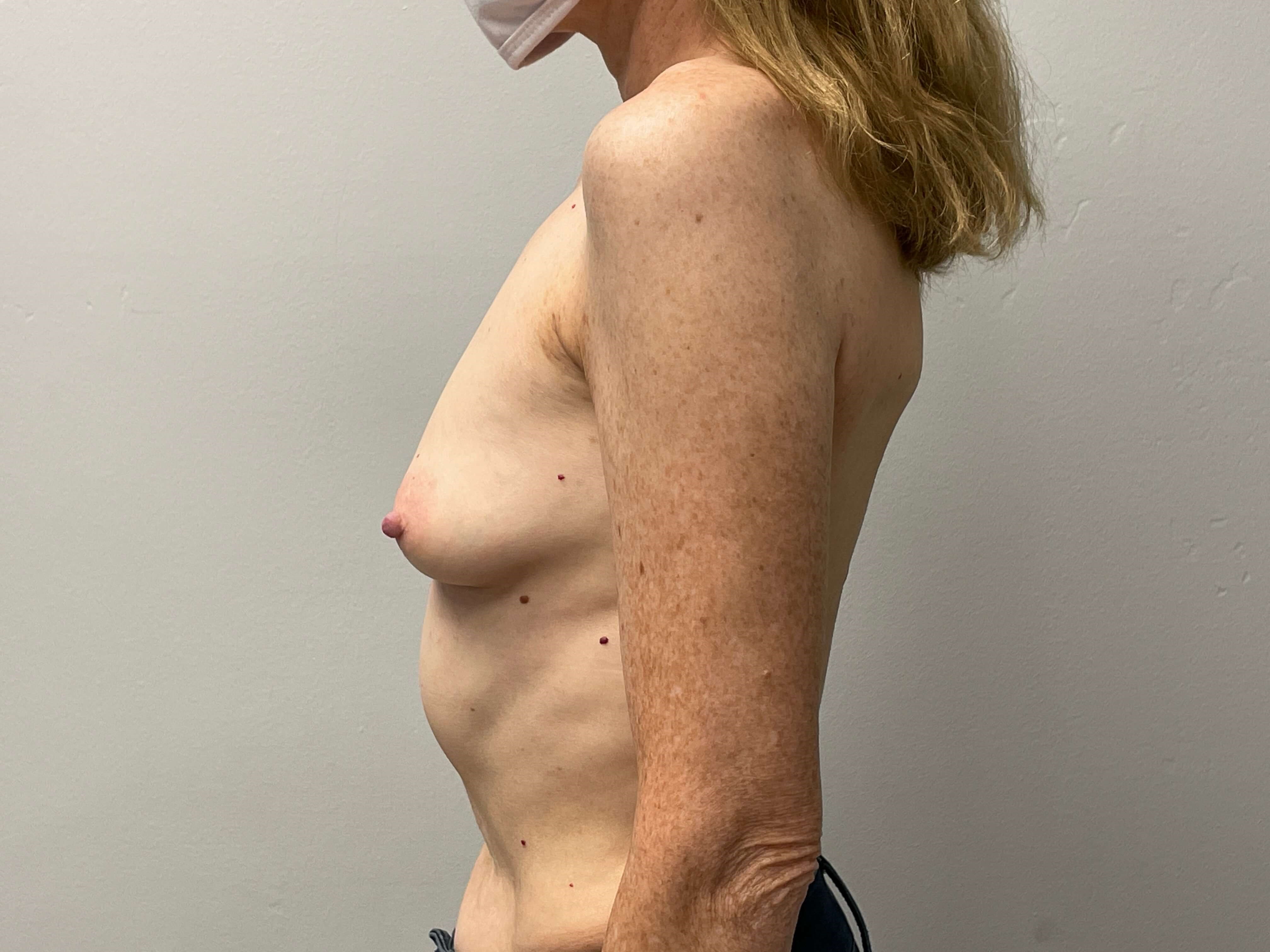 Westlake Woman Has Breast Aug Before