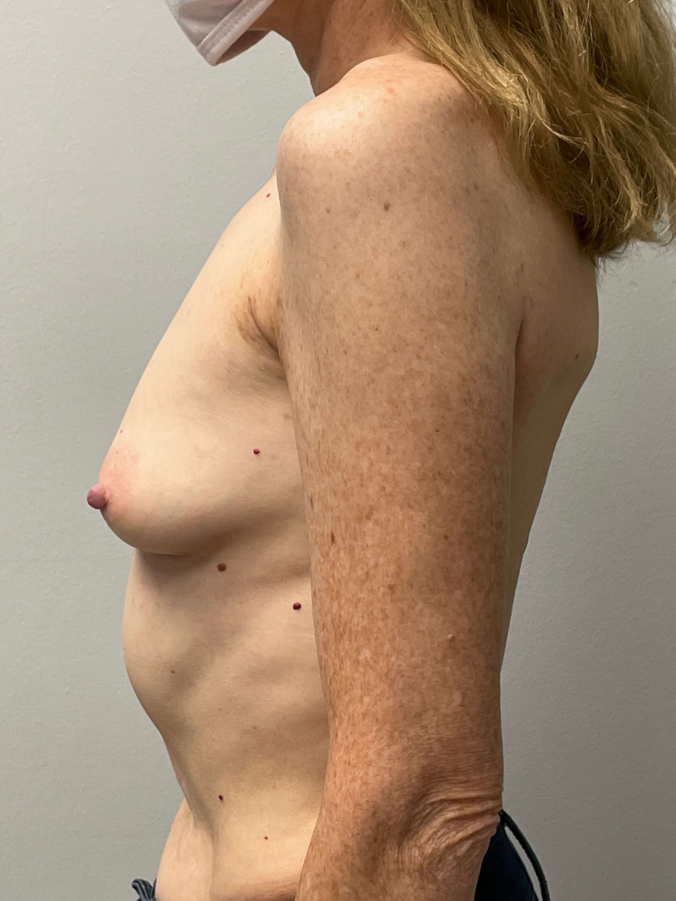 Westlake Woman Has Breast Aug Before