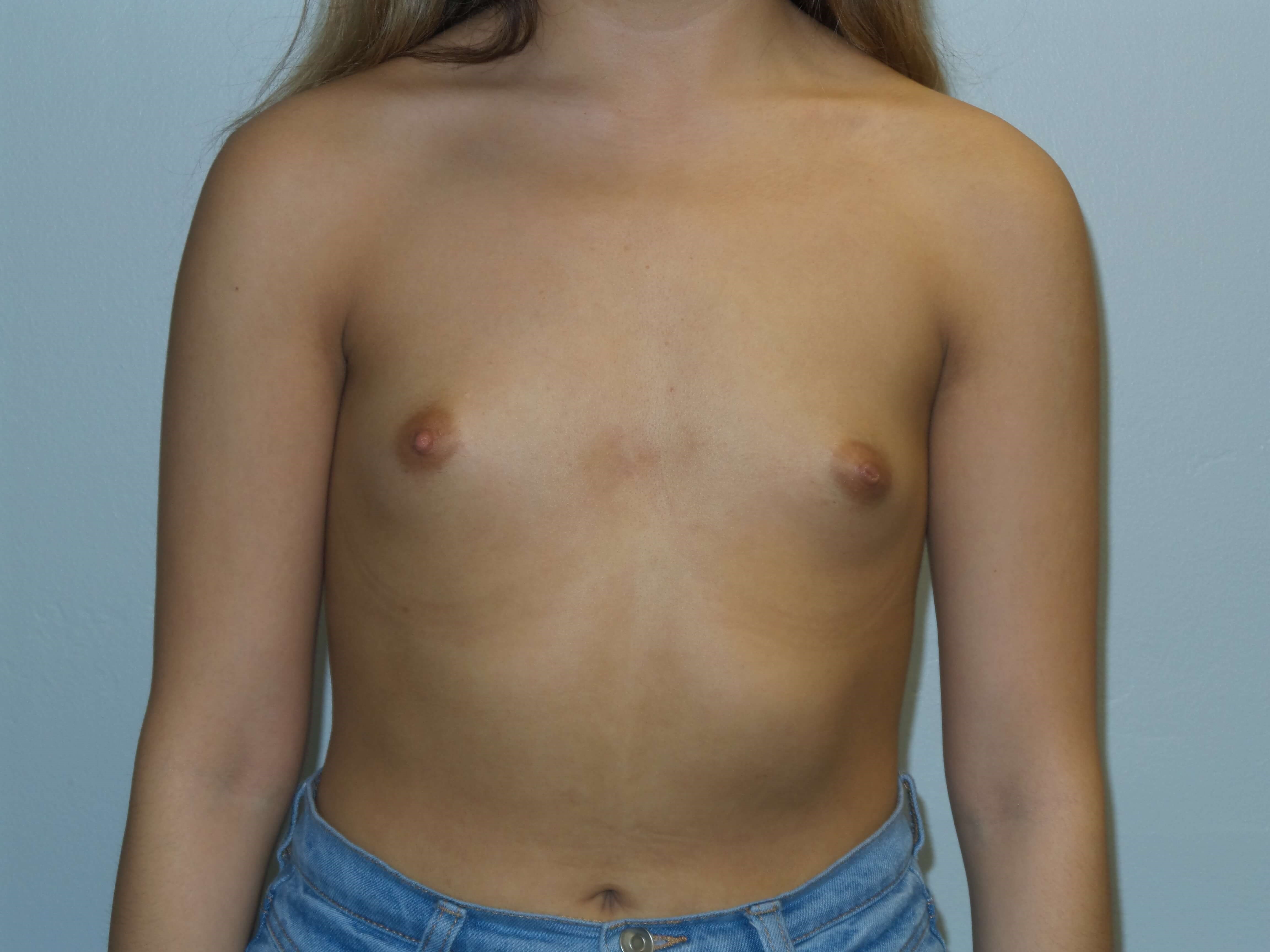 Westlake Woman Has Breast Aug Before