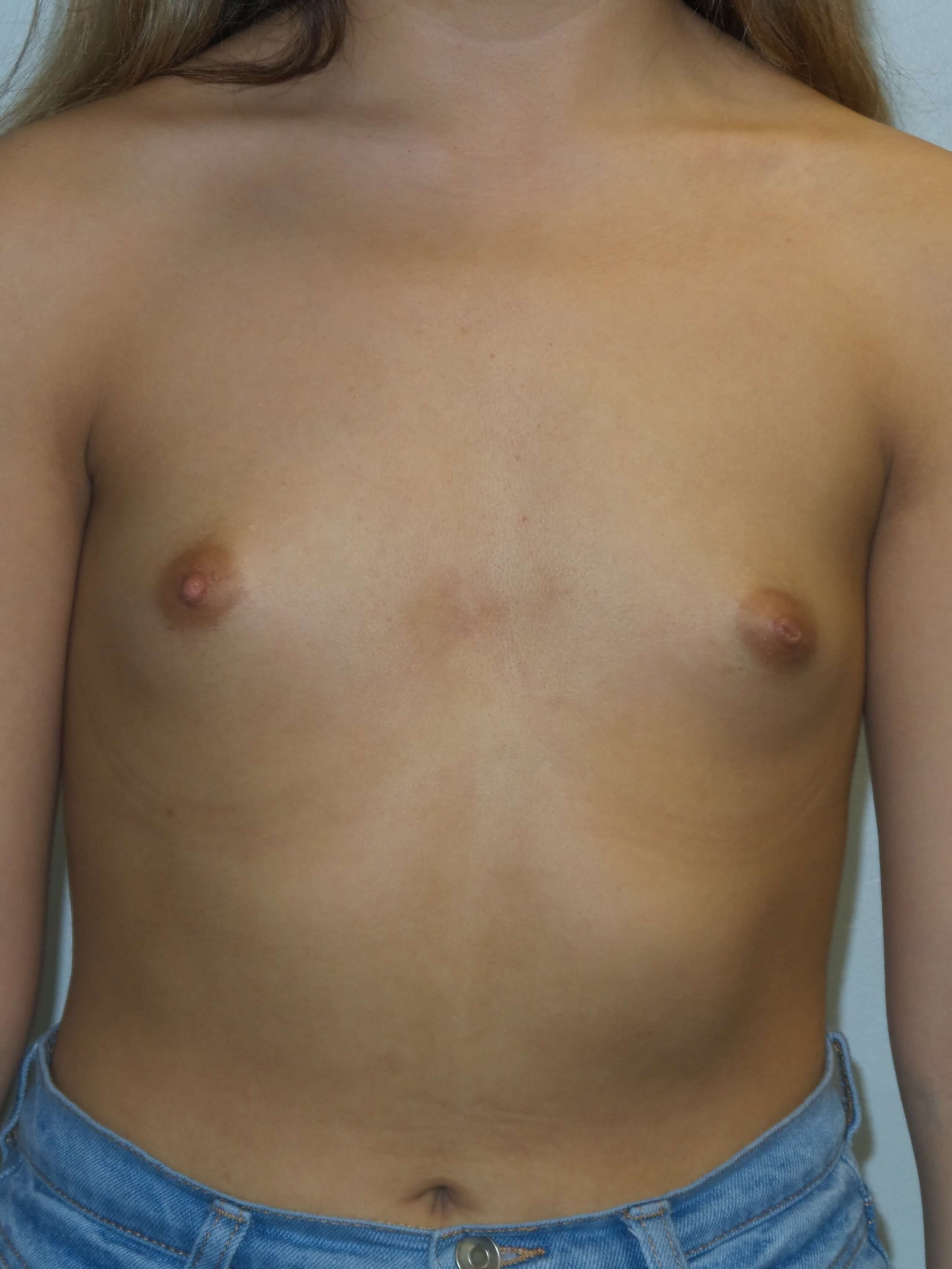 Westlake Woman Has Breast Aug Before