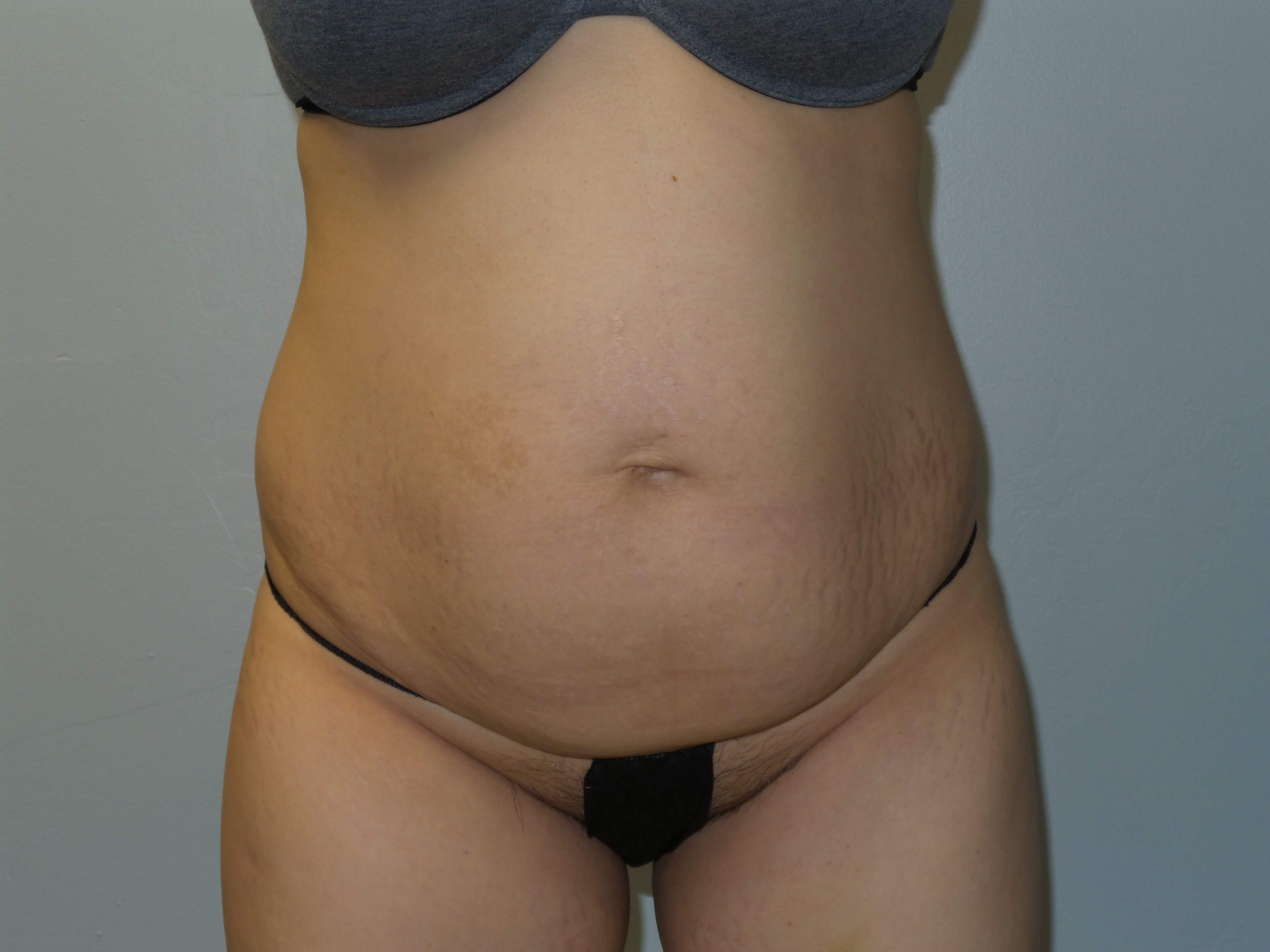 Woman Has Tummy Tuck Lipo Before
