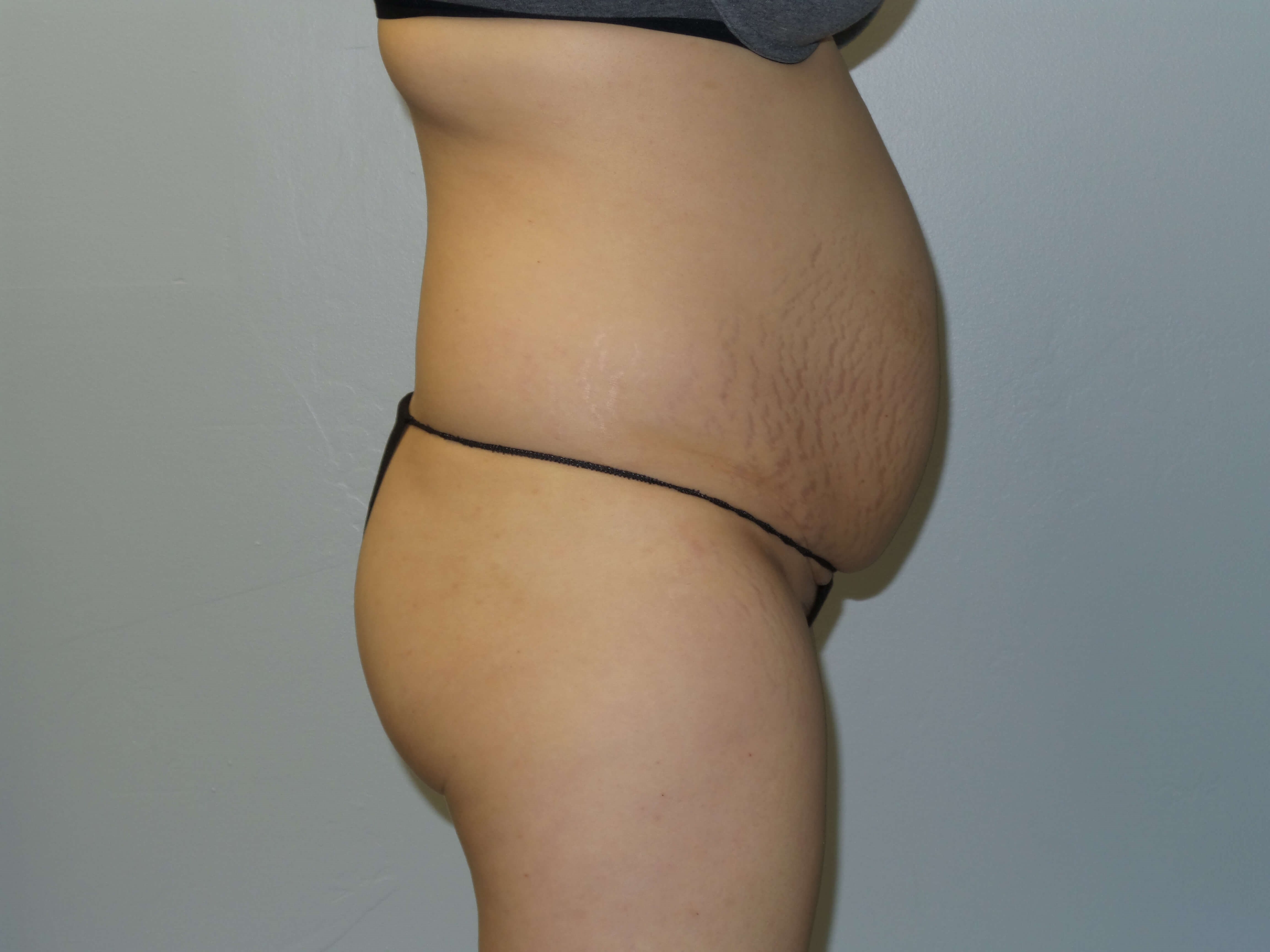 Woman Has Tummy Tuck Lipo Before