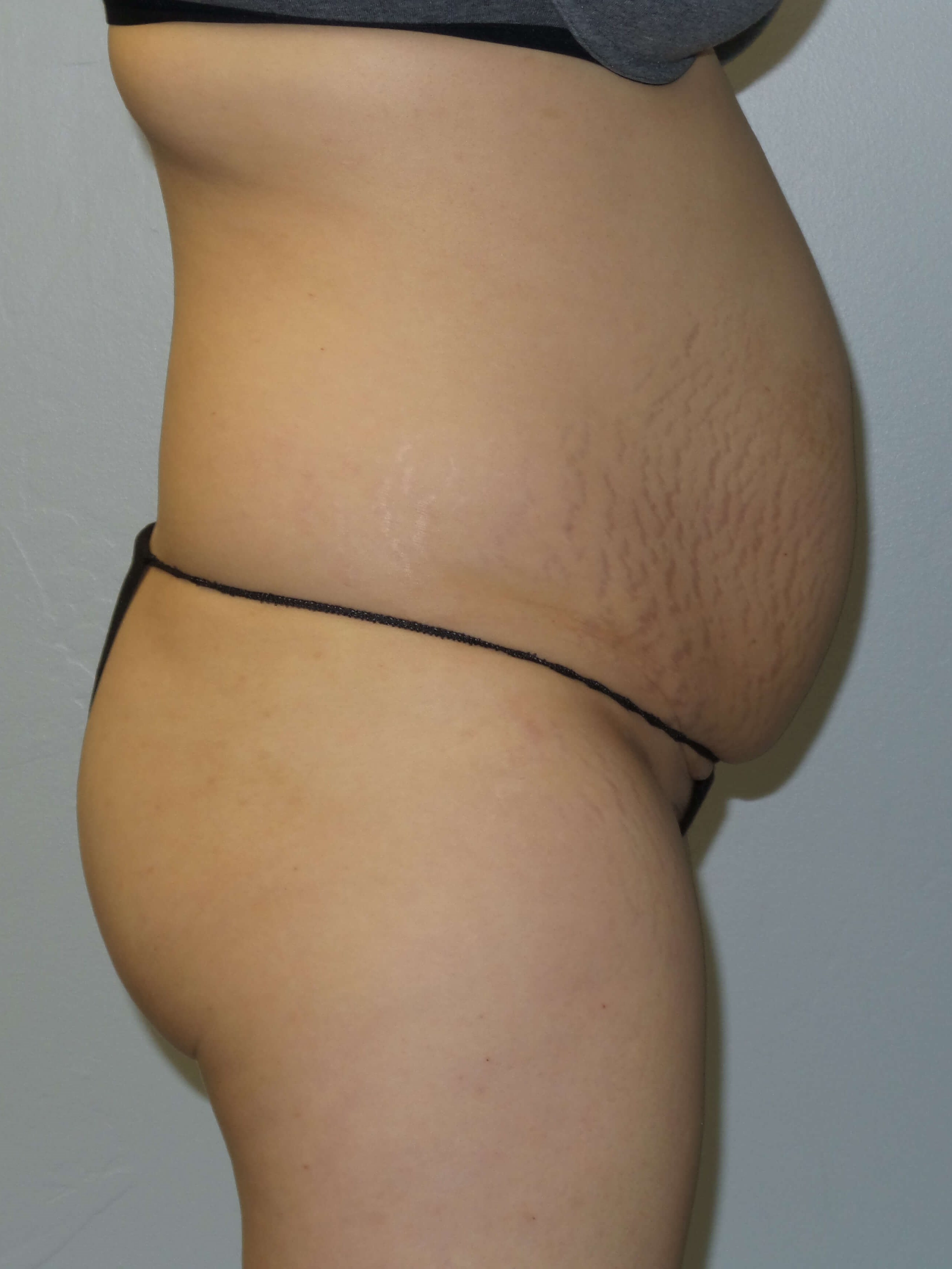 Woman Has Tummy Tuck Lipo Before