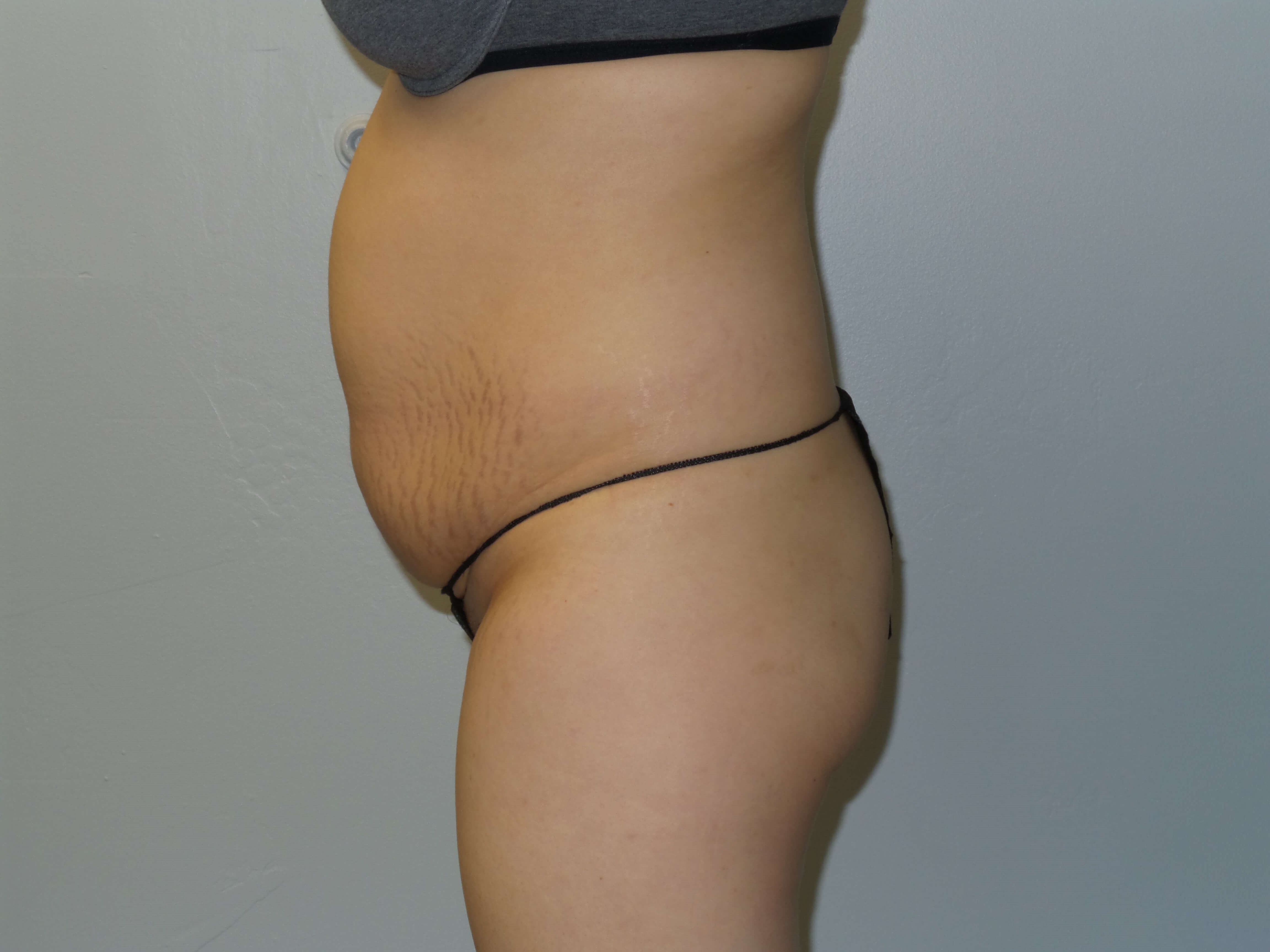 Woman Has Tummy Tuck Lipo Before