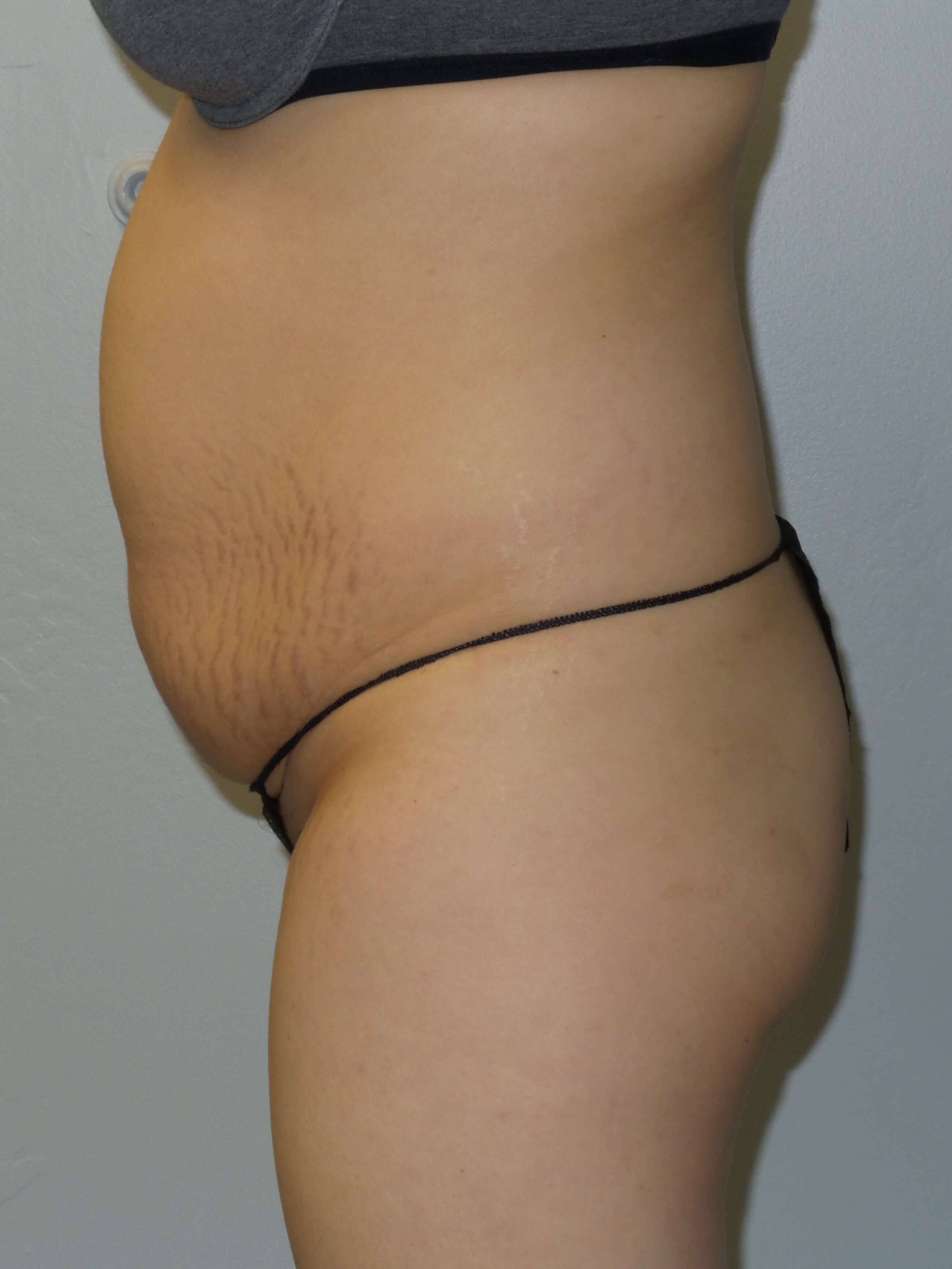 Woman Has Tummy Tuck Lipo Before
