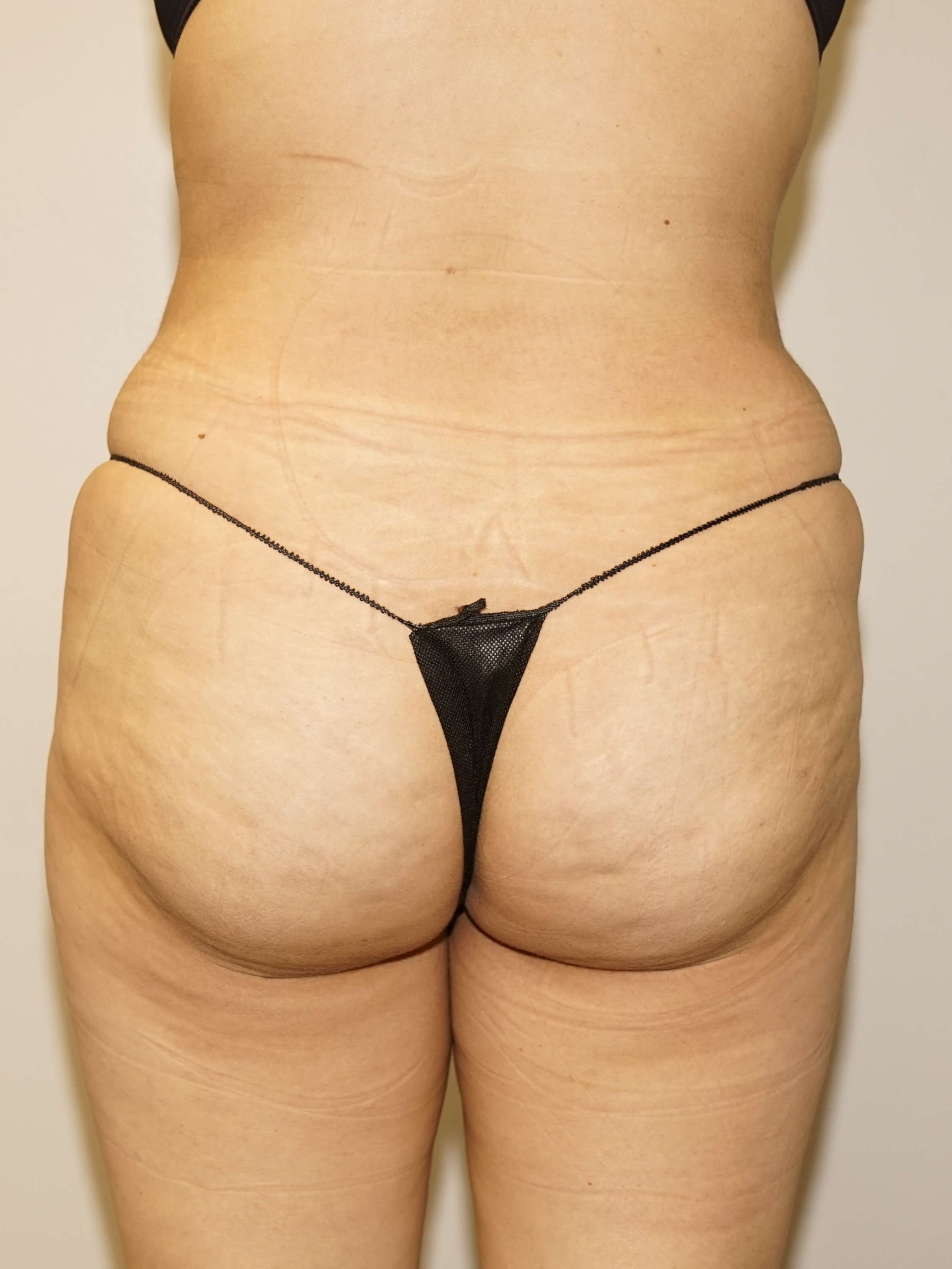 Woman has BBL Butt Lift After