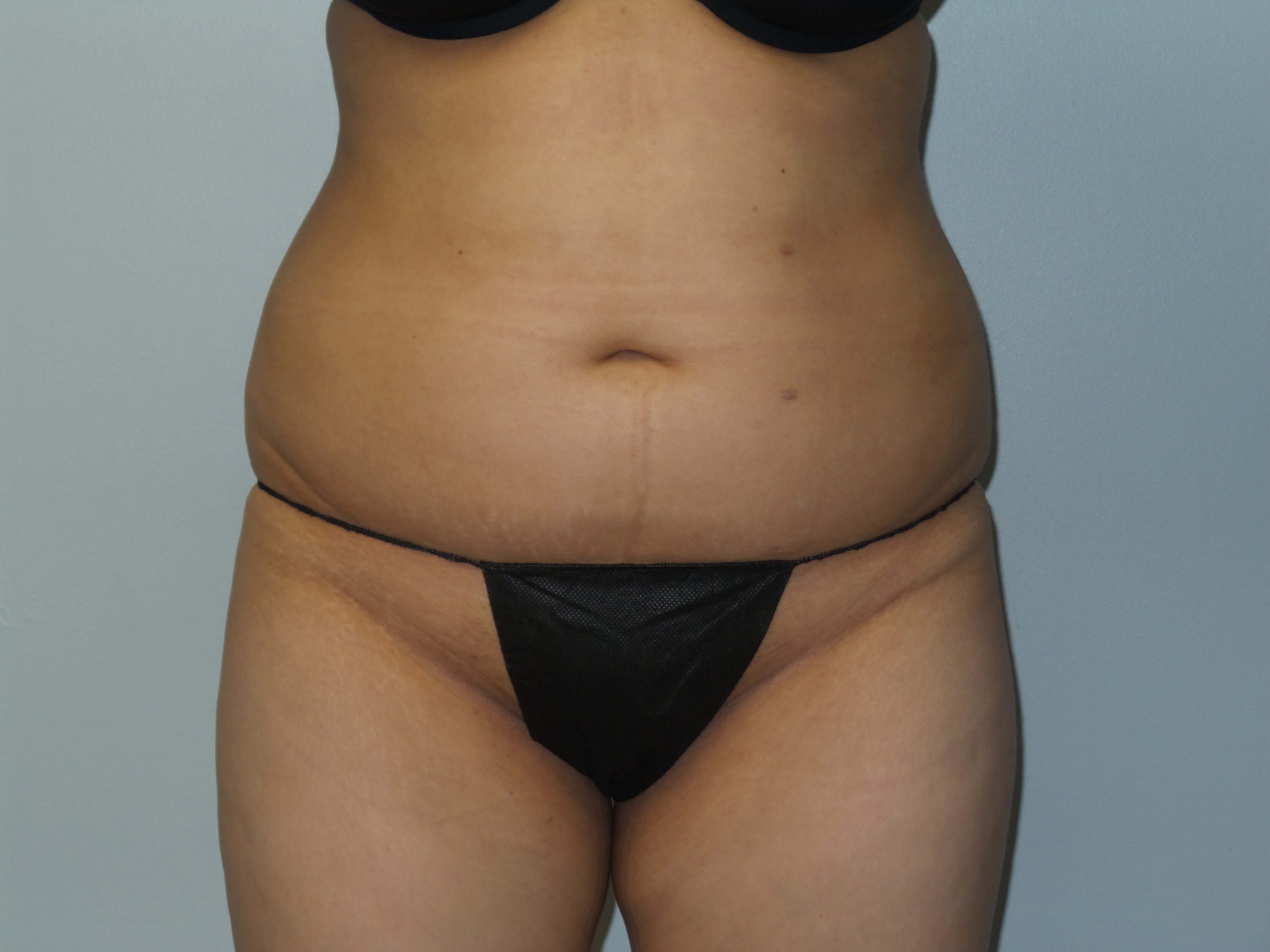 Woman has BBL Butt Lift Before