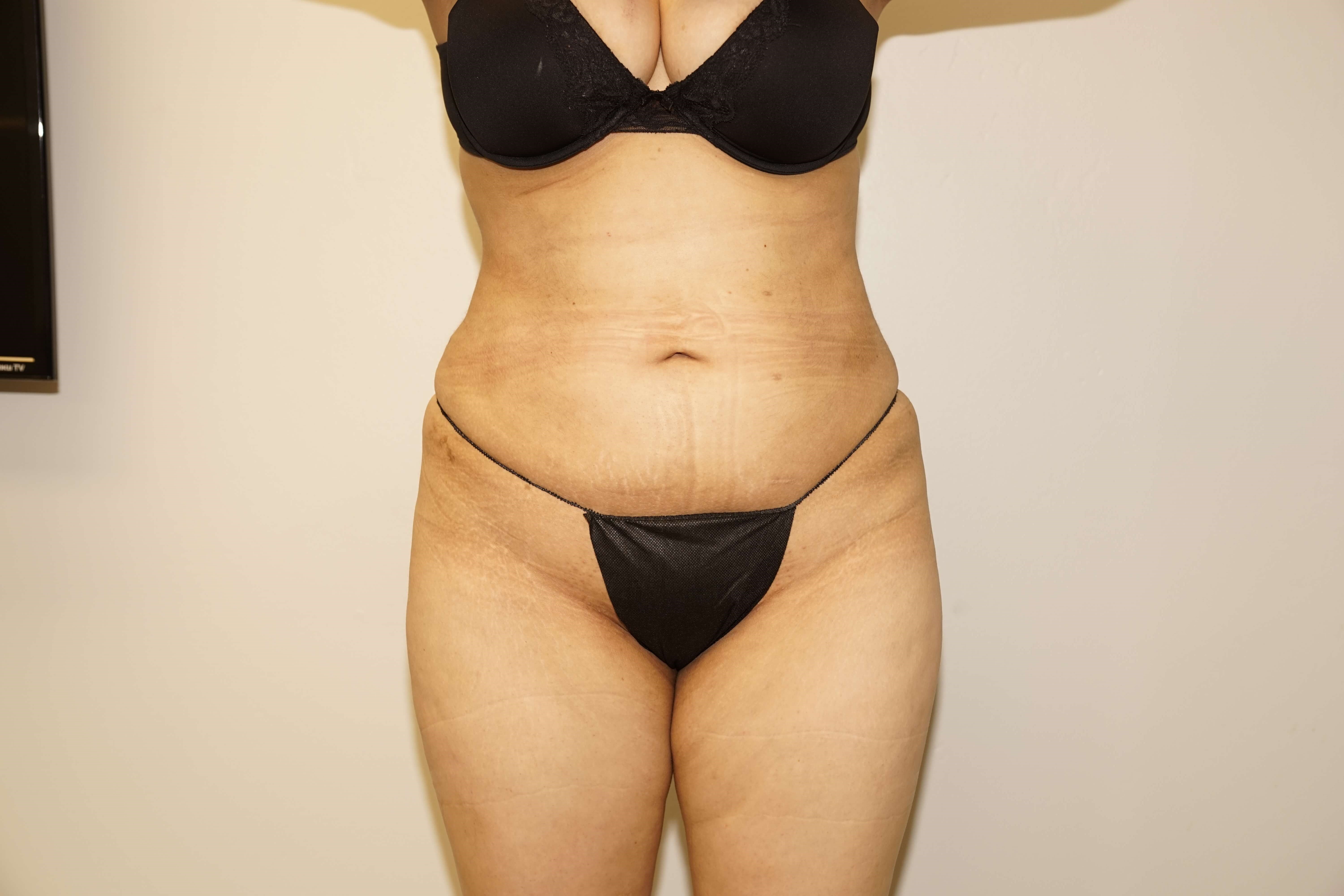 Woman has BBL Butt Lift After