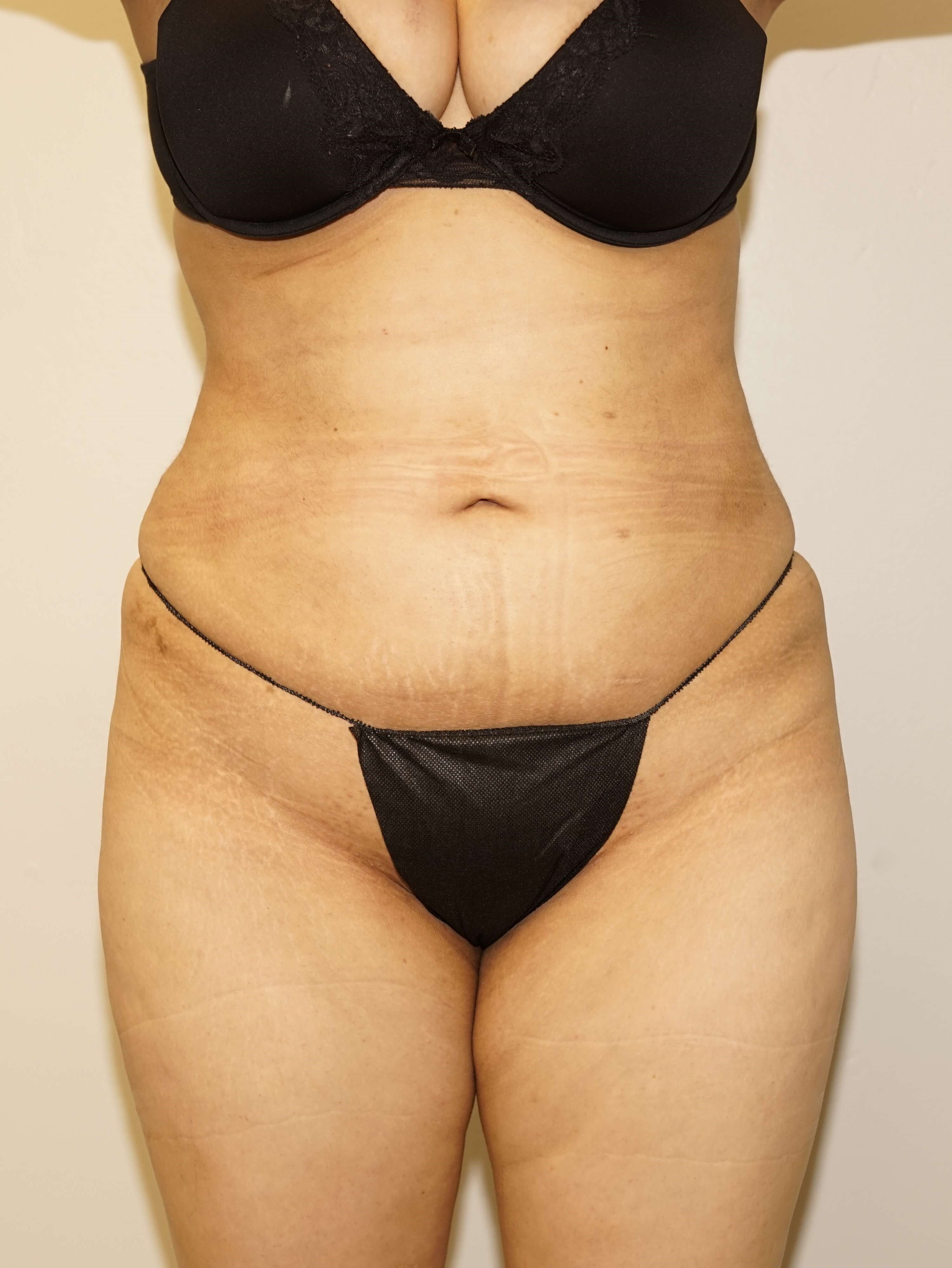 Woman has BBL Butt Lift After