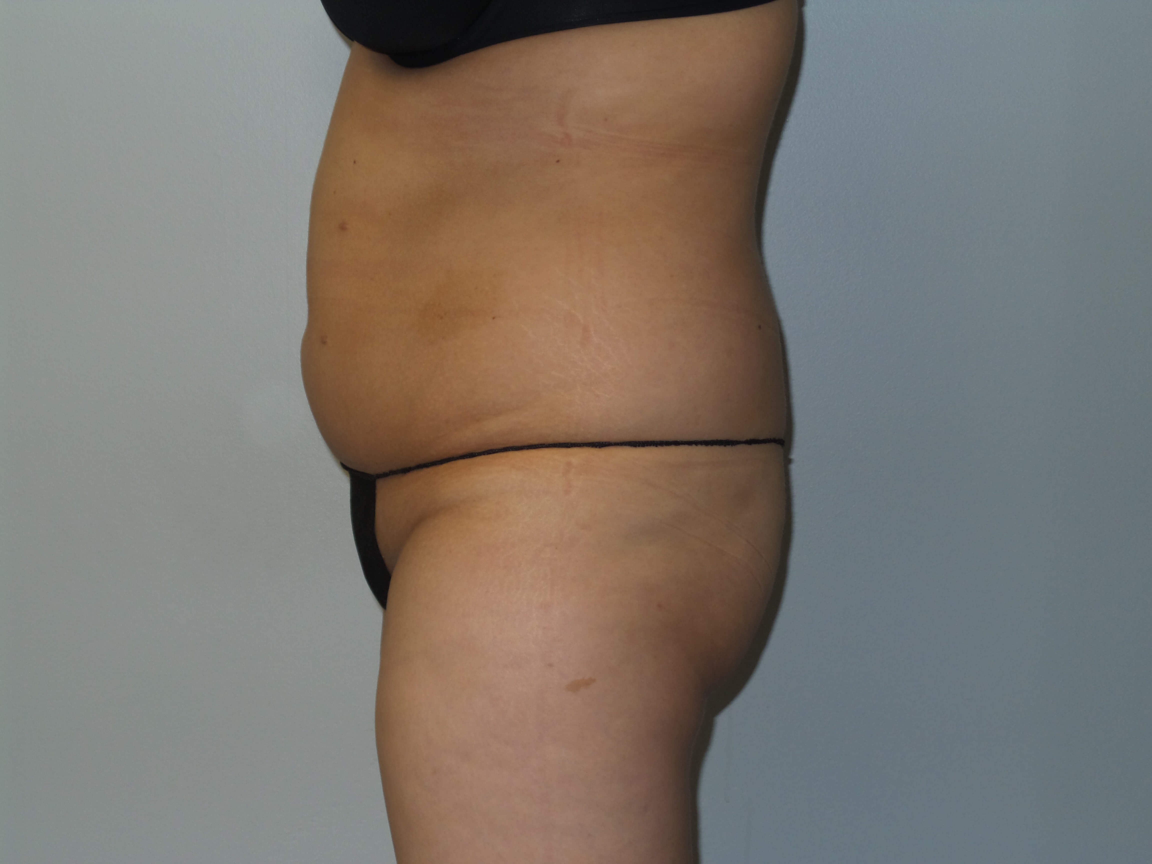Woman has BBL Butt Lift Before