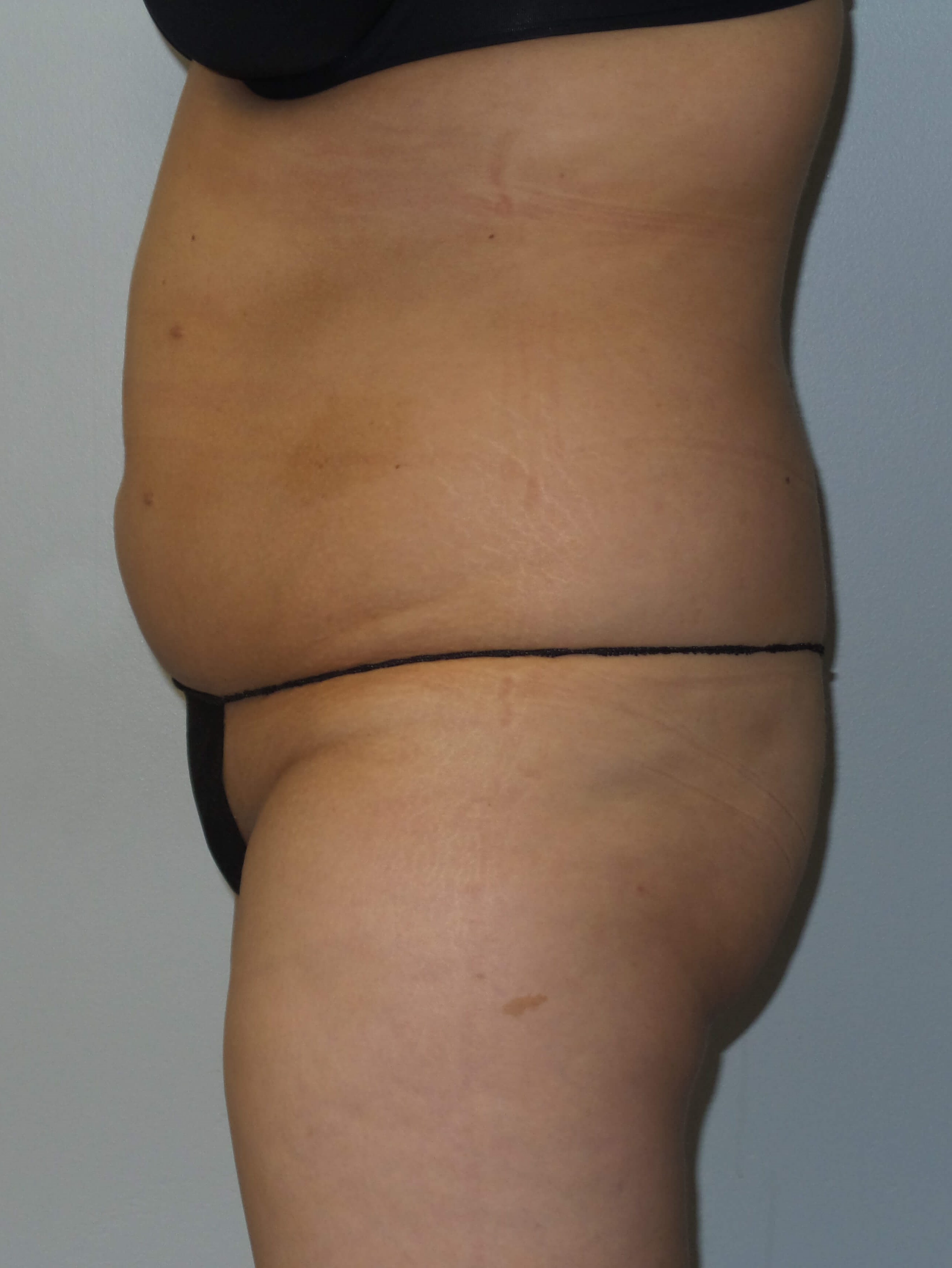 Woman has BBL Butt Lift Before