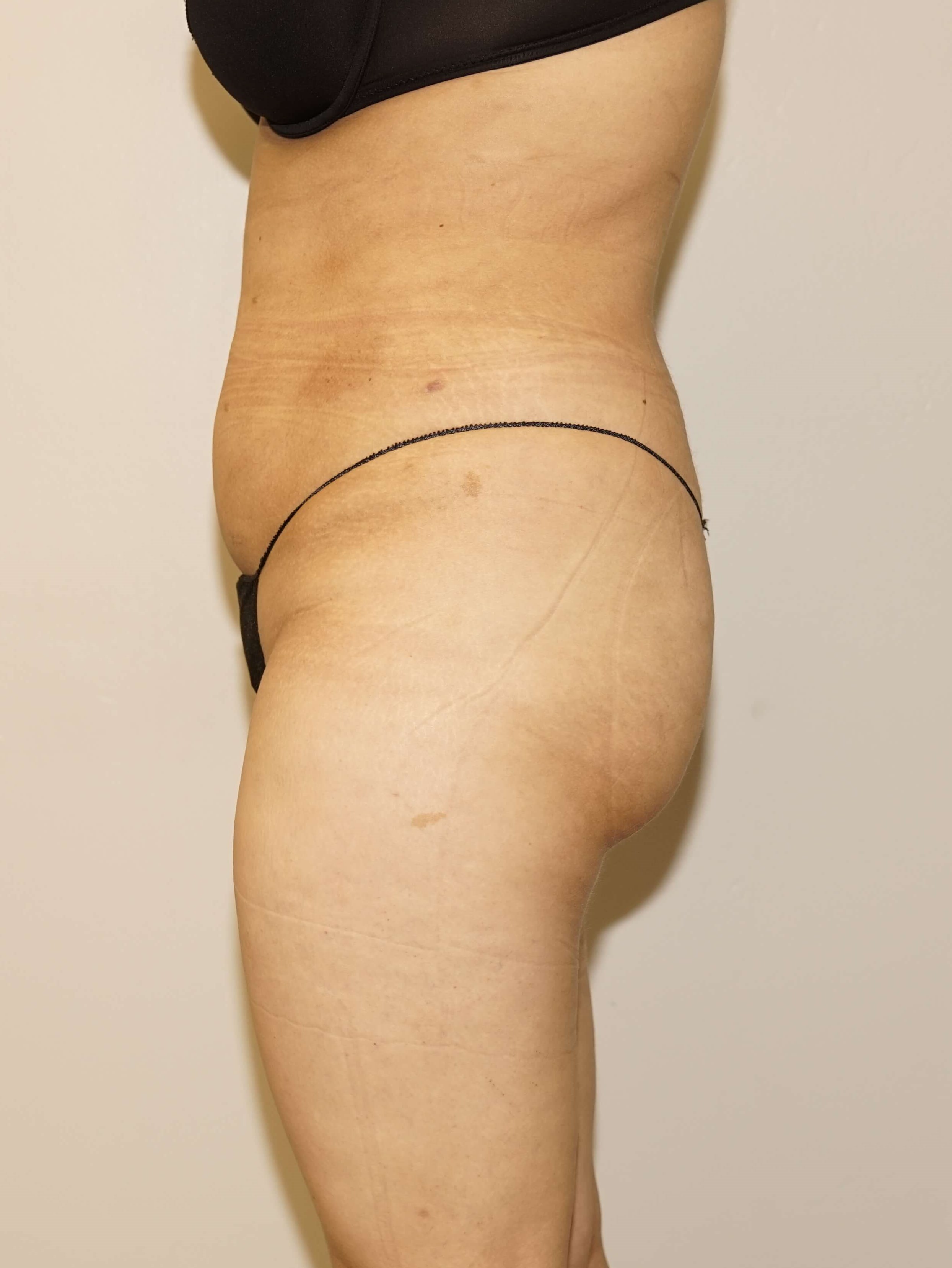 Woman has BBL Butt Lift After