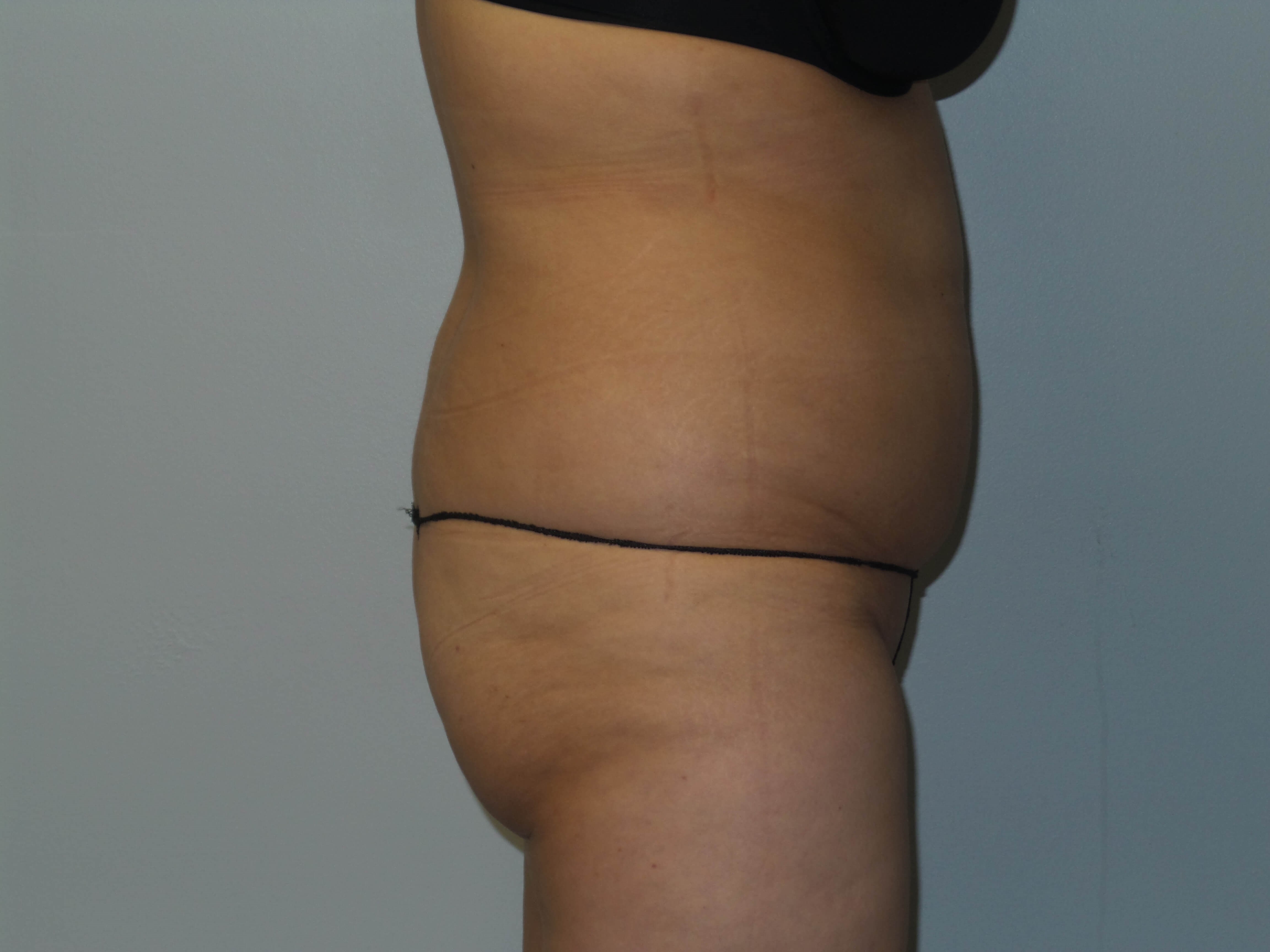 Woman has BBL Butt Lift Before