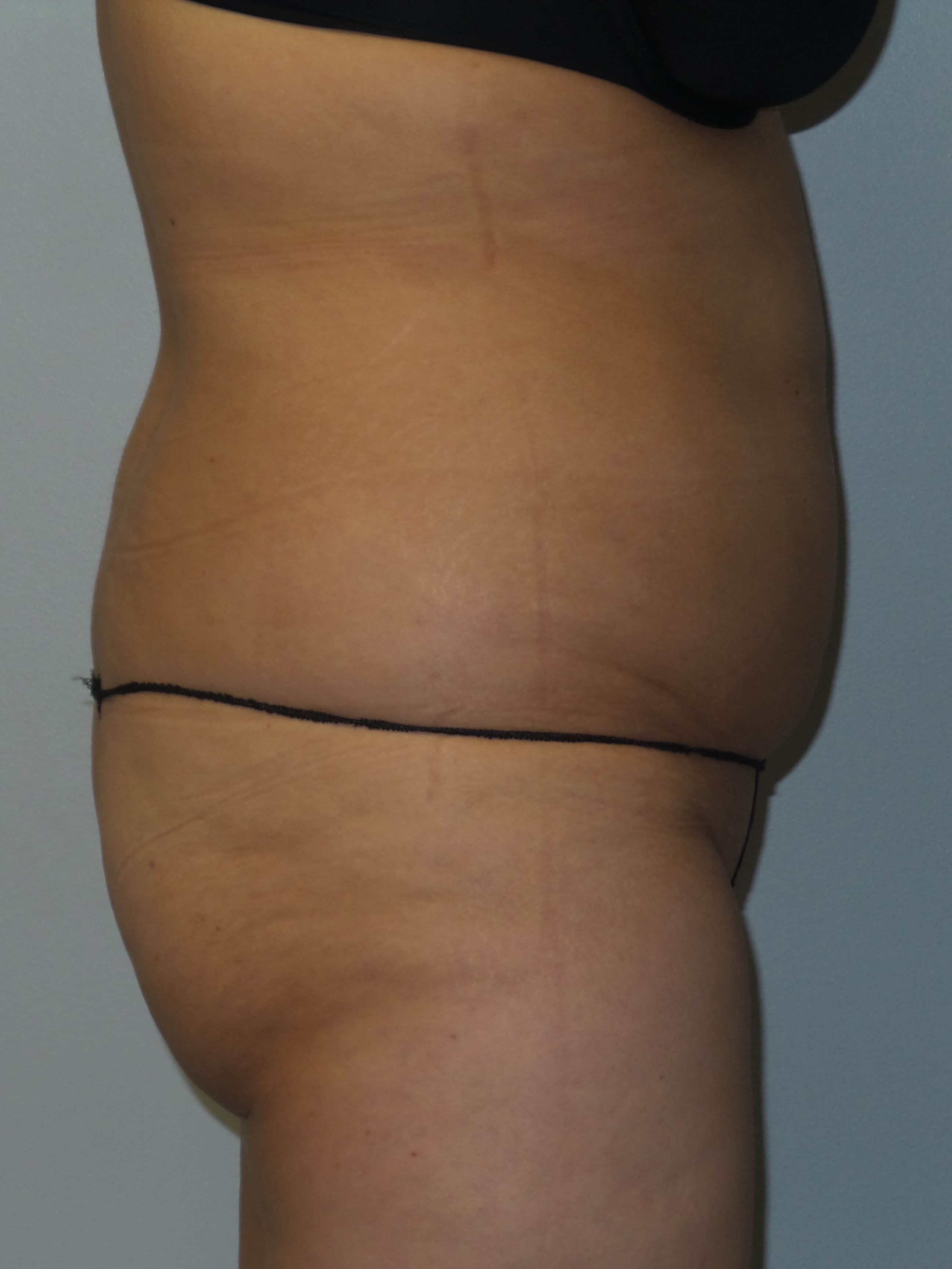 Woman has BBL Butt Lift Before